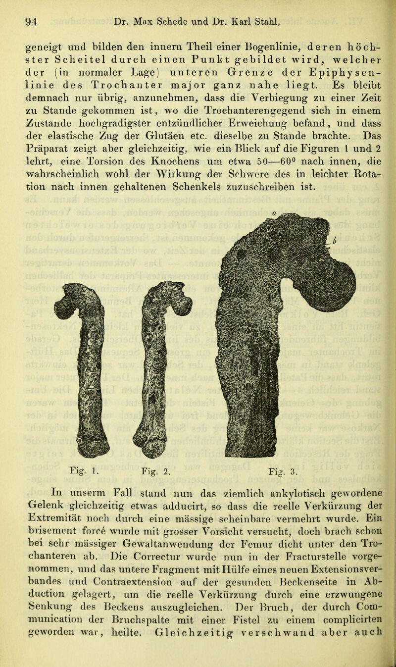 geneigt und bilden den innern Theil einer Bogenlinie, deren höch- ster Scheitel durch einen Punkt gebildet wird, welcher der (in normaler Lage) unteren Grenze der Epiphysen- linie des Trochanter major ganz nahe liegt. Es bleibt demnach nur übrig, anzunehmen, dass die Verbiegung zu einer Zeit zu Stande gekommen ist, wo die Trochanterengegend sich in einem Zustande hochgradigster entzündlicher Erweichung befand, und dass der elastische Zug der Glutäen etc. dieselbe zu Stande brachte. Das Präparat zeigt aber gleichzeitig, wie ein Blick auf die Figuren l und 2 lehrt, eine Torsion des Knochens um etwa 50—60^ nach innen, die wahrscheinlich wohl der Wirkung der Schwere des in leichter Rota- tion nach innen gehaltenen Schenkels zuzuschreiben ist. Fig. 1. Fig. 2. Fig. 3. In unserm Fall stand nun das ziemlich ankylotisch gewordene Gelenk gleichzeitig etwas adducirt, so dass die reelle Verkürzung der Extremität noch durch eine mässige scheinbare vermehrt wurde. Ein brisement force wurde mit grosser Vorsicht versucht, doch brach schon bei sehr massiger Gewaltanwendung der Femur dicht unter den Tro- chanteren ab. Die Correctur wurde nun in der Fracturstelle vorge- nommen, und das untere Fragment mit Hülfe eines neuen Extensionsver- bandes und Contraextension auf der gesunden Beckenseite in Ab- duction gelagert, um die reelle Verkürzung durch eine erzwungene Senkung des Beckens auszugleichen. Der Bruch, der durch Com- munication der Bruchspalte mit einer Fistel zu einem complicirten geworden war, heilte. Gleichzeitig verschwand aber auch