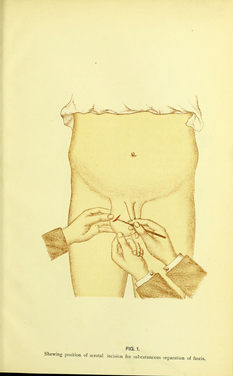 Shewing position of scrotal incision for subcutaneous separation of fascia.