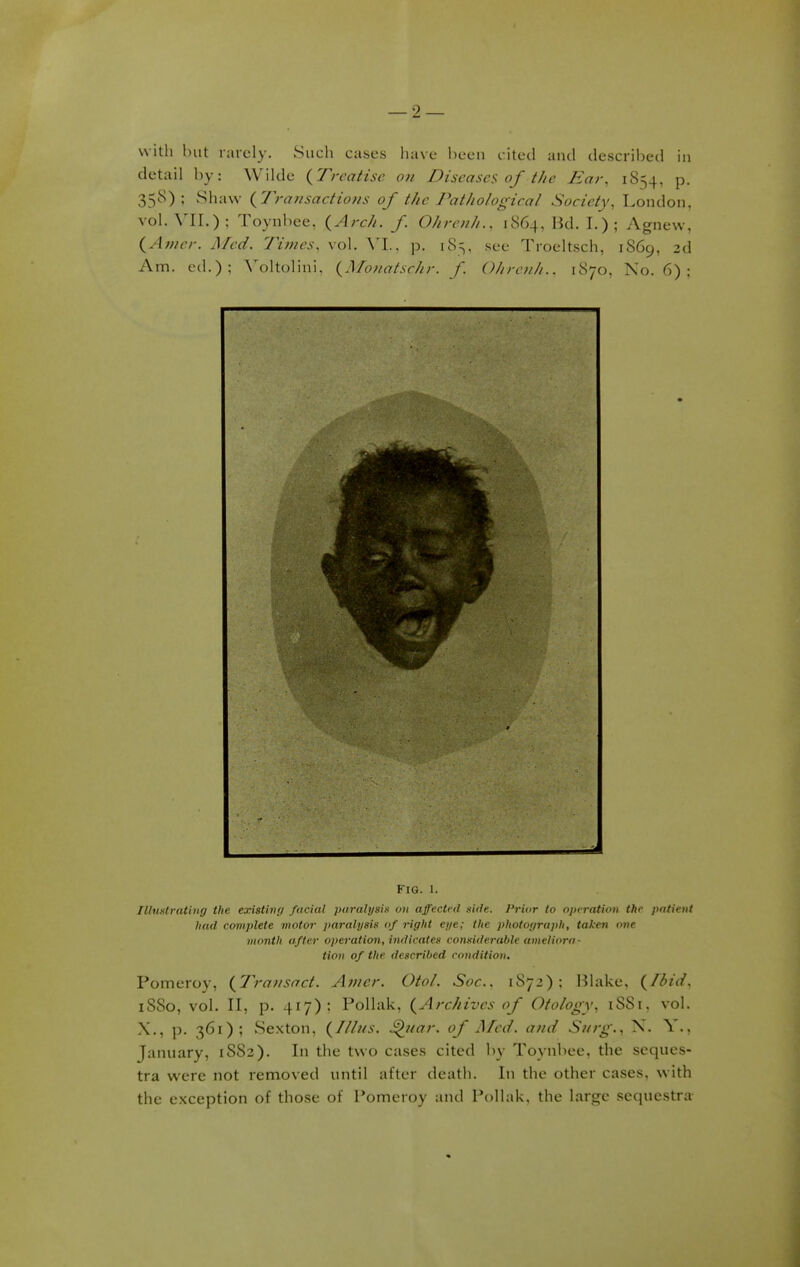 with but rarely. Such cases have been cited and described in detail by: Wilde (Treatise on Diseases of the Ear, 1854, p. 358); Shaw (Transactions of the Pathological Society, London, vol. VII.): Toynbee, (Arch, f Ohrenh., 1864, Bd. I.) ; Agnew, (Amer. Med. Times, vol. VI.. p. 185, see Troeltsch, 1869, 2d Am. ed.); Voltolini, (Monatschr. f Ohrenh., 1870, No. 6) ; '• ■ - Fig. 1. Illustrating the existing facial paralysis on affected side. Prior to operation the patient had complete motor paralysis of right eye; the photograph, taken one month after operation, indicates considerable ameliora- tion of the described condition. Pomeroy, ('Transact. Amer. Otol. Soc. 1872); Blake, (Ibid, 1SS0, vol. II, p. 417); Pollak, (Archives of Otology, 1SS1. vol. X., p. 361); Sexton, (Tllus. Quar. of Med. and Surg., X. Y., January, 1S82). In the two cases cited by Toynbee, the seques- tra were not removed until after death. In the other cases, with the exception of those of Pomeroy and Pollak, the large sequestra