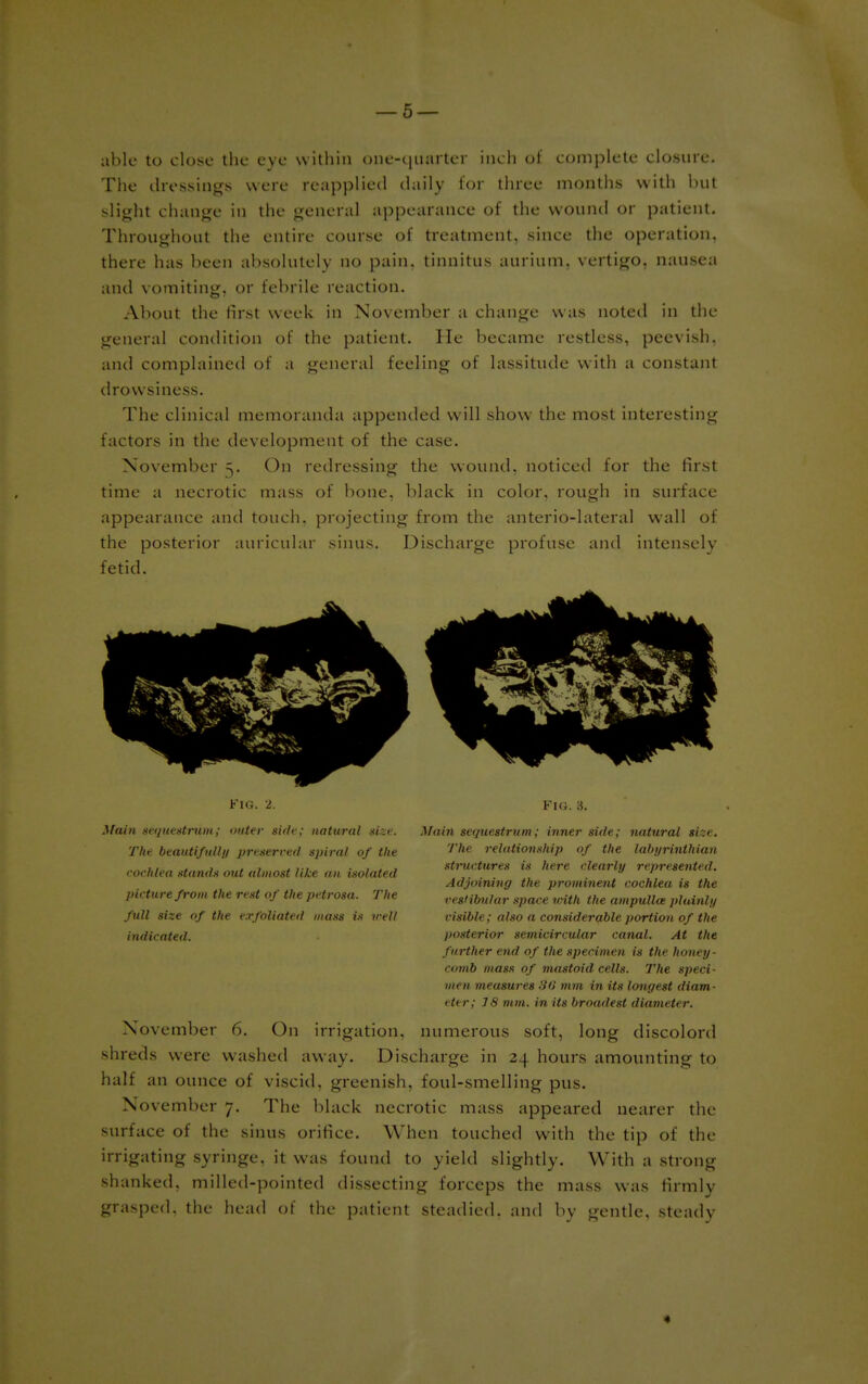 able to close the eve within one-quarter inch of complete closure. The dressings were reapplied daily for three months with but slight change in the general appearance of the wound or patient. Throughout the entire course of treatment, since the operation, there has been absolutely no pain, tinnitus aurium. vertigo, nausea and vomiting, or febrile reaction. About the fust week in November a change was noted in the general condition of the patient. lie became restless, peevish, and complained of a general feeling of lassitude with a constant drowsiness. The clinical memoranda appended will show the most interesting factors in the development of the case. November 5. On redressing the wound, noticed for the first time a necrotic mass of bone, black in color, rough in surface appearance and touch, projecting from the anterio-lateral wall of the posterior auricular sinus. Discharge profuse and intensely fetid. Fig. 2. Main sequestrum; outer side; natural size. The beautifiilh/ preserved s/iiral of the cochlea stands out almost like an isolated picture from the rest of the petrosa. The full size of the exfoliated mass is veil indicated. FIG. 3. Main sequestrum; inner side; natural size. The relationship of the labyrinthian structures is here clearly represented. Adjoining the prominent cochleu is the vestibular space vnth the ampulla; plainly visible; also a considerable portion of the posterior semicircular canal. At the further end of the specimen is the honey- comb mass of mastoid cells. The speci- men measures 88 mm in its longest diam- eter; J 8 mm. in its broadest diameter. November 6. On irrigation, numerous soft, long discolord shreds were washed away. Discharge in 24 hours amounting to half an ounce of viscid, greenish, foul-smelling pus. November 7. The black necrotic mass appeared nearer the surface of the sinus orifice. When touched with the tip of the irrigating syringe, it was found to yield slightly. With a strong shanked, milled-pointed dissecting forceps the mass was firmly grasped, the head of the patient steadied, and by gentle, steady «