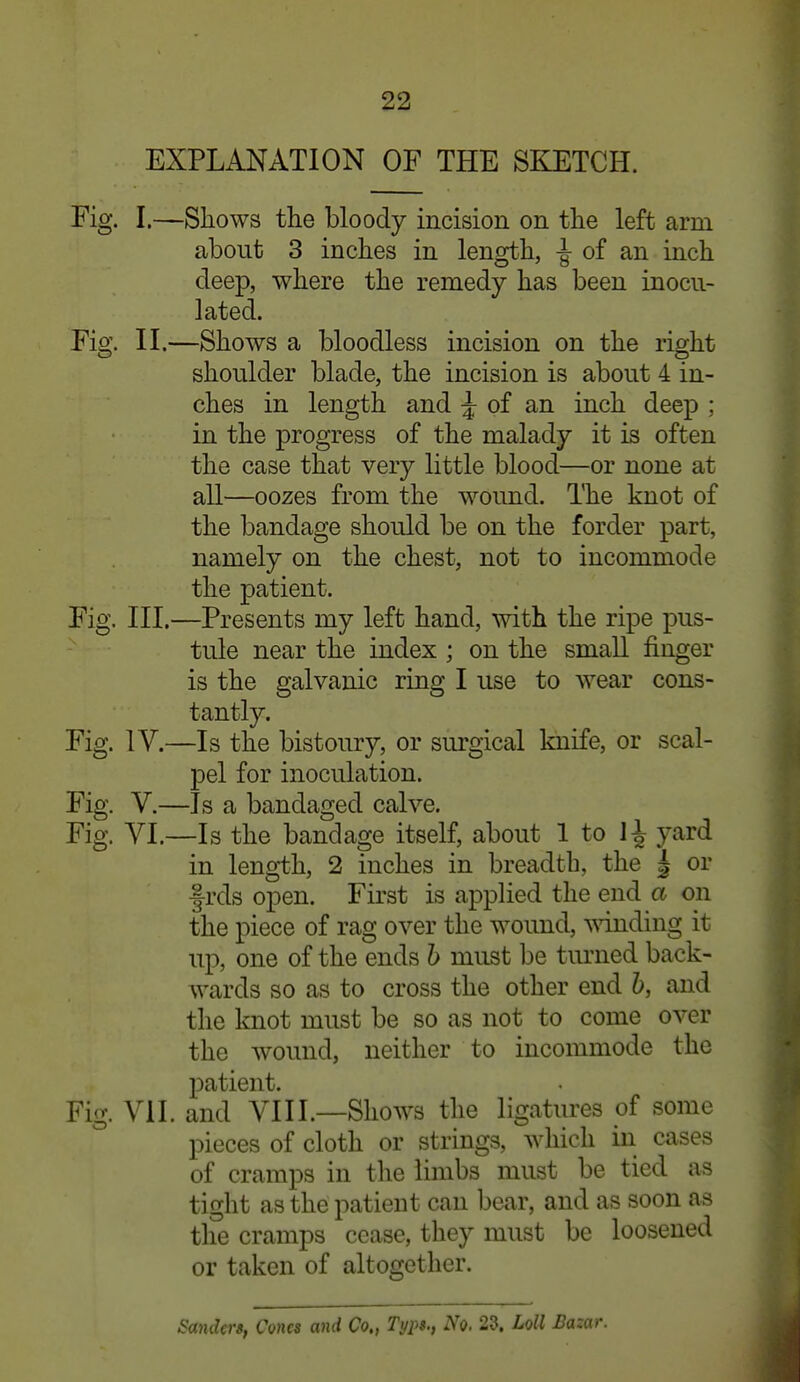 EXPLANATION OF THE SKETCH. Fig. I.—Shows the bloody incision on the left arm about 3 inches in length, ^ of an inch deep, where the remedy has been inocu- lated. Fig. II.—Shows a bloodless incision on the right shoulder blade, the incision is about 4 in- ches in length and ^ of an inch deep ; in the progress of the malady it is often the case that very little blood—or none at all—oozes from the wound. The knot of the bandage should be on the forder part, namely on the chest, not to incommode the patient. Fig. III.—Presents my left hand, mth the ripe pus- ^ tule near the index ; on the small finger is the galvanic ring I use to wear cons- tantly. Fig. IV.—Is the bistoury, or surgical knife, or scal- pel for inoculation. Fig. V.—Is a bandaged calve. Fig. VI.—Is the bandage itself, about 1 to H yard in length, 2 inches in breadth, the | or f rds open. First is applied the end a on the piece of rag over the wound, ^^inding it up, one of the ends h must be timied back- wards so as to cross the other end h, and the knot must be so as not to come over the wound, neither to incommode the patient. Fig. VII. and VIII.—Shows the ligatures of some pieces of cloth or strings, which in cases of cramps in the limbs must be tied as tight as the patient can bear, and as soon as the cramps cease, they must be loosened or taken of altogether. Sanders, Cones and Co., Typs., No. 23. Loll Bazar.