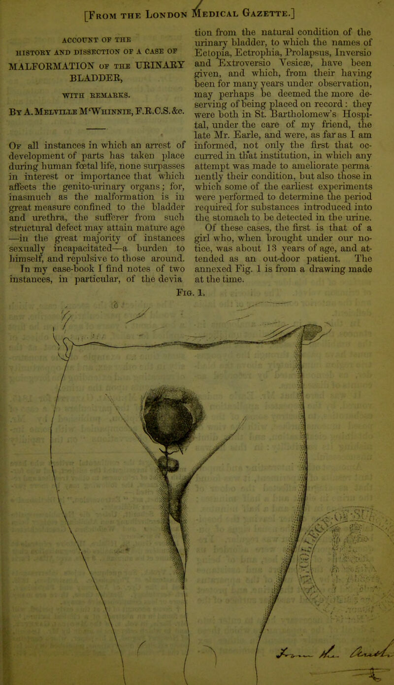 [From the London Medical Gazette.] ACCOFNT OP THE HISTORY AND DISSKCTION OF A CASE OF MALFOEMATION of the URINAEY BLADDER, with eemaeks. By a. Meithus M'Whinnie, F.E.C.S. &c. Of all instances in which an an'cst of development of parts lias takeu i)lace during human foetal hfe, none surpasses in interest or importance that wliich affects the genito-urinaiy organs; for, inasmuch as the malfonnation is in great measure confined to the bladder and urethra, the sufferer fi-om such structural defect may attain mature age —in the great majonty of instances sexually incapacitated—a bm'den to Jiimselt, and repvdsive to those ai-ound. Tn my case-book I find notes of two instances, in paiticular, of the devia Fi&. 1. tion from the natural condition of the urinary bladder, to which the names of Ectopia, Ectrophia, Prolapsus, Inversio and Exti'oversio Vesicae, have been given, and which, from their having been for many yeai'S under observation, may perhaps be deemed the more de- serving of being placed on record : they were both in St. Bartholomew's Hospi- tal, under the care of my friend, the late Mr. Earle, and were, as far as I am informed, not only the first that oc- cim'ed in tliat institution, in which any attempt was made to ameliorate perma nently their condition, but also those in which some of the eaiiiest experiments were j)erformed to determine the period requiied for substances introduced into the stomach to be detected in the urine. Of these cases, the fu'st is that of a girl who, when brought under oiu' no- tice, was about 13 years of age, and at- tended as an out-door patient. The annexed Fig. 1 is from a drawing made at the time.