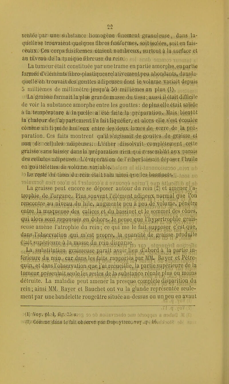 SGiî;i'é()tpai'-'we'=8ubslauco homogèoe tiiiemciiL graauleuse, dans la- qdeHese Iroufvaient quelques libres fiisiformes, so[tisolées, soil en fais- ceaux. Ce3 corps fusiformes élaicnl nombreux,; surtQut^ laiSurface et au mvea'U'deila.luniqijel'lbreuse duroin. . m;], ' (niii i h La tumeur clait constituée par une trame en partie amorphe!, en par lie form'é'cd''élémènjtS'ribro^plaisliqucsrQlatiYeijiientpeuia}^on(lan^te q!uBl]ëioh *lrafflvai'ti'ie3igouttes adipeuses dont le volume, variait depi^is 5 millièmes de millimètre jusqu'à-50 millièmes au plus (1). l'Laigraisse formait la plus grande masse.du, tissu; aussi il était diflicile de voir la substance amorphe entre les gouttes: dfl pluSrell&était spUde àia.'temTîérata're à'iaqu'el)le=;a!llétiérfaiter,laopréparalion^.,Mais,;bjepiôt la'chaileur deil'appaplementfFa faitliquéfier,- et alors elle,s'est écoulée cômfme uhrliqBideihudleuK entre les deux lames,de verresde la pf|é- paration. Ces faits montrent qu'il •s'agiasailL^de■goulte^ïl3e^|g)V,9issfj3f;| noarf^dé icelluilDS>:adipeuae3:niL'iélhéT ?ài^oJiYatt-0ompléle(ntjnt,jG,p(lte gr'aisse 'sans! laisser dans la .rpa-éporafcion -rieûfjq ui-^iJeaseail^lû t r^u x parais des eellulesfadipeusesi^Liévaporiiiioin) deil^élhevilaijsailidépofteEiVhvlije en;^uttèleti«sidi8i'volamei,iYariableJijj;frim i;l eli-jii'umoisBo.oo ..ruei nf: ' 0 lîEiregte Idiii tiss» i d m jjciii! était Bala wiigig'tie îlQ?i li- j nos j;o •loiuffliot noii oao'n st îtjIuods's ù avuoiqà eahu'l 9un àJluDfflih b[ sb La graisse peut encore se déposer autour du rein (2) et amenerJ'a- rç^9p,tf^,au,ç^i,\f^a%^ pe,i},à .pp^ |^eijjqljii|}e,, pén.^tr.e 9Pimlff,l?imupj^S^idÉi% ça!|ges,^t,flj^^,^^n,ef,.^ties,o^,i^3et^^^^^ seuse amène l'atrophie du rein; ce qui me le fail|^|UP,ppser, ç|cst|que, 6La^t,?u.l?é.'îi'^fôl%^Jî^M?AfcÇeàtl»'^'rro iGD,9)nor;nài1 fioi.}oT}r, ^?)nsa;fl|^5.e/,yafjLqa,qfip|j;fti,i;epH9^^^ E^f;li,^çp^rfepre de.l^ lRPlWTiI?EéfiWMimP}B!i?3,fl9Sifi?,,(J^j^a détruite. La maladie peut amener la presq|:^,çPi0|^P^^l9 ^[,sç|rUip_Q,4^ rein; ainsi MM. Rayer et Bauchet ont vu la glande représentée seule- ment par unebandelette rougeâtre située au-dessus ou un neu en avant :rnqv^ !'(ll)-î'Hoy'.'ÇL.!l!,iig!.')25raio5 y, ob noi.iRv;osrlo oiirr 9ti0(]r]in b micfiiO •ii(fl)xC6itiraeT3aiiB'ldfait.otoservô-pàriiDupuytroDviT«5\iTiit'5^