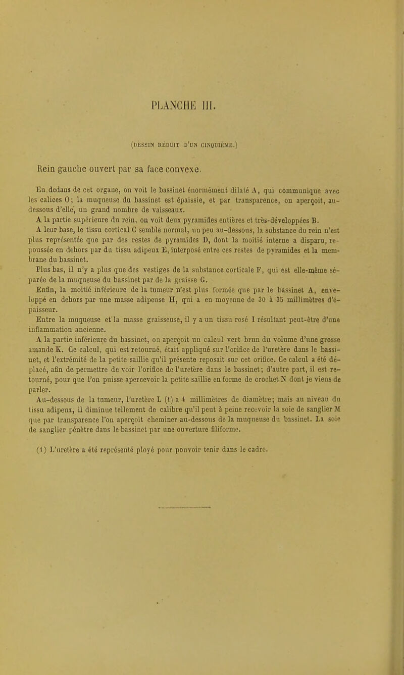 PLANCIll': III. (dessin réduit d'un CINOmÉME.) Rein gauche ouvert par sa face convexe. Eu dedans de cet organe, on voit le bassinet énormément dilaté A, qui communique avpc les calices 0; la muqueuse du bassinet est épaissie, et par transparence, on aperçoit, au- dessous d'elle', un grand nombre de vaisseaux. A la partie supérieure du rein, on voit deux pyramides entières et très-développées B. A. leur base, le tissu cortical C semble normal, un peu au-dessous, la substance du rein n'est plus représentée que par des restes de pyramides D, dont la moitié interne a disparu, re- poussée en dehors par du tissu adipeui E, interposé entre ces restes de pyramides et la mem- brane du bassinet. Plus bas, il n'y a plus que des vestiges de la substance corticale F, qui est elle-même sé- parée de la muqueuse du bassinet par de la graisse G. Enfin, la moitié inférieure de la tumeur n'est plus formée que par le bassinet A, enve- loppé en dehors par une masse adipeuse H, qui a en moyenne de 30 à 35 millimètres d'é- paisseur. Entre la muqueuse et la masse graisseuse, il y a un tissu rosé 1 résultant peut-être d'une inflammation ancienne. A la partie inférieure du bassinet, on aperçoit un calcul vert brun du volume d'une grosse amande K. Ce calcul, qui est retourné, était appliqué sur l'orifice de l'uretère dans le bassi- net, et l'extrémité de la petite saillie qu'il présente reposait sur cet orifice. Ce calcul a été dé- placé, afin de permettre de voir l'orifice de l'uretère dans le bassinet; d'autre part, il est re- tourné, pour que l'on puisse apercevoir la petite saillie en forme de crochet N dont je viens de parler. Au-dessous de la tumeur, l'uretère L (1) a i millimètres de diamètre; mais au niveau du tissu adipeux, il diminue tellement de calibre qu'il peut à peine recuvoir la soie de sanglier M que par transparence l'on aperçoit cheminer au-dessous de la muqueuse du bassinet. La soie de sanglier pénètre dans le bassinet par une ouverture filiforme. (1) L'uretère a été représenté ployé pour pouvoir tenir dans le cadre.