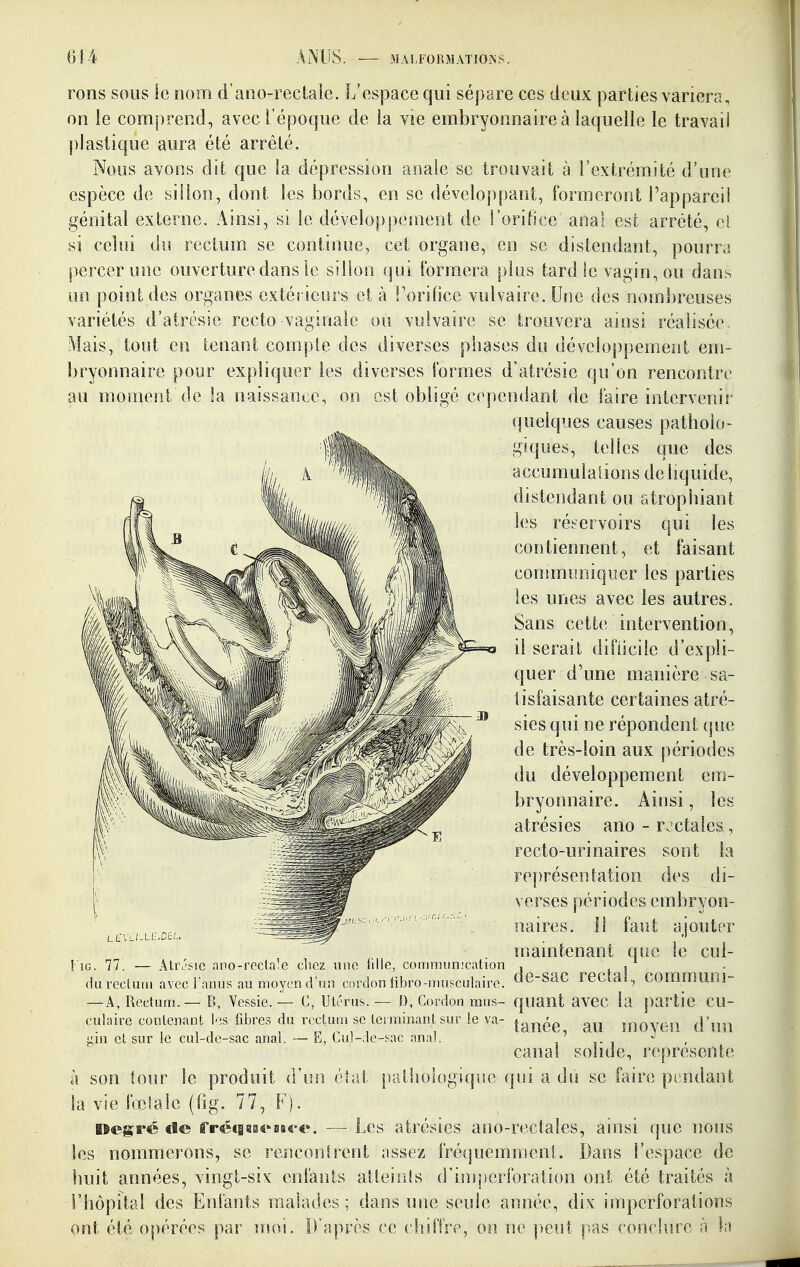 rons sous ie nom d'ano-rectaie. L'espace qui sépare ces deux parties variera, on le comprend, avec l'époque de ia vie embryonnaire à laquelle le travail plastique aura été arrêté. Nous avons dit que la dépression anale se trouvait à l'extrémité d'une espèce de sillon, dont les bords, en se développant, formeront l'appareil génital externe. Ainsi, si le développement de l'orifice anal est arrêté, ci si celui du rectum se continue, cet organe, en se distendant, pourra percer une ouverture dans le sillon qui formera plus tard le vagin, ou dans un point des organes extéî leurs et à l'orifice vulvaire.Une des nombreuses variétés d'airésic recto vaginale ou volvaire se trouvera ainsi réalisée. Mais, tout en tenant compte des diverses phases du développement em- bryonnaire pour expliquer les diverses formes d'atrésie qu'on rencontre au moment de la naissance, on est obligé cependant de faire intervenir quelques causes patholo- giques, telles que des accumulaiions de liquide, distendant ou atrophiant les réservoirs qui les contiennent, et faisant communiquer les parties les unes avec les autres. Sans cette intervention, il serait difficile d'expli- quer d'une manière sa- tisfaisante certaines atré- sies qui ne répondent que de très-loin aux périodes du développement em- bryonnaire. Ainsi, les atrésies ano - r. étales, recto-urinaires sont la représentation des di- verses périodes embryon- naires. Il faut ajouter maintenant que le cui- dureclutn avec l'anus au moyen d'un cordon iibro-musculaire. de-SaC rectal, COmmuni- — A, Rectum. — B, Yessie. — C, Utérus. — I), Cordon mus- quant avCC la partie Cu- tanée, au moyen d'un canal solide, représente à son tour le produit a un état patiiologique qui a du se faire pt'udant la vie fœlale (fig. 77, F). Wegré de fré<i8fleiiB«-e. — Les atrésies ano-rectales, ainsi que nous les nommerons, se rencontrent assez fréquemment. Dans l'espace de huit années, vingt-six enfants atteiofs d'inq)crforation ont été traités à l'hôpital des Enfants malades ; dans une seule année, dix imperforations ont été opérées par nu>i. D'après ce chiffre, on ne peut pas conclure à la LEIlI-LE.DIÎL lîG. 77. — Alrésic aiiQ-recta'e chez une tille, communication mi B, Yessie. — C, Utérus, culaire contenant les fibres du rectum se terminant sur le va- gin et sur le cul-de-sac anal. — E, Cu!-dc-snc anal.