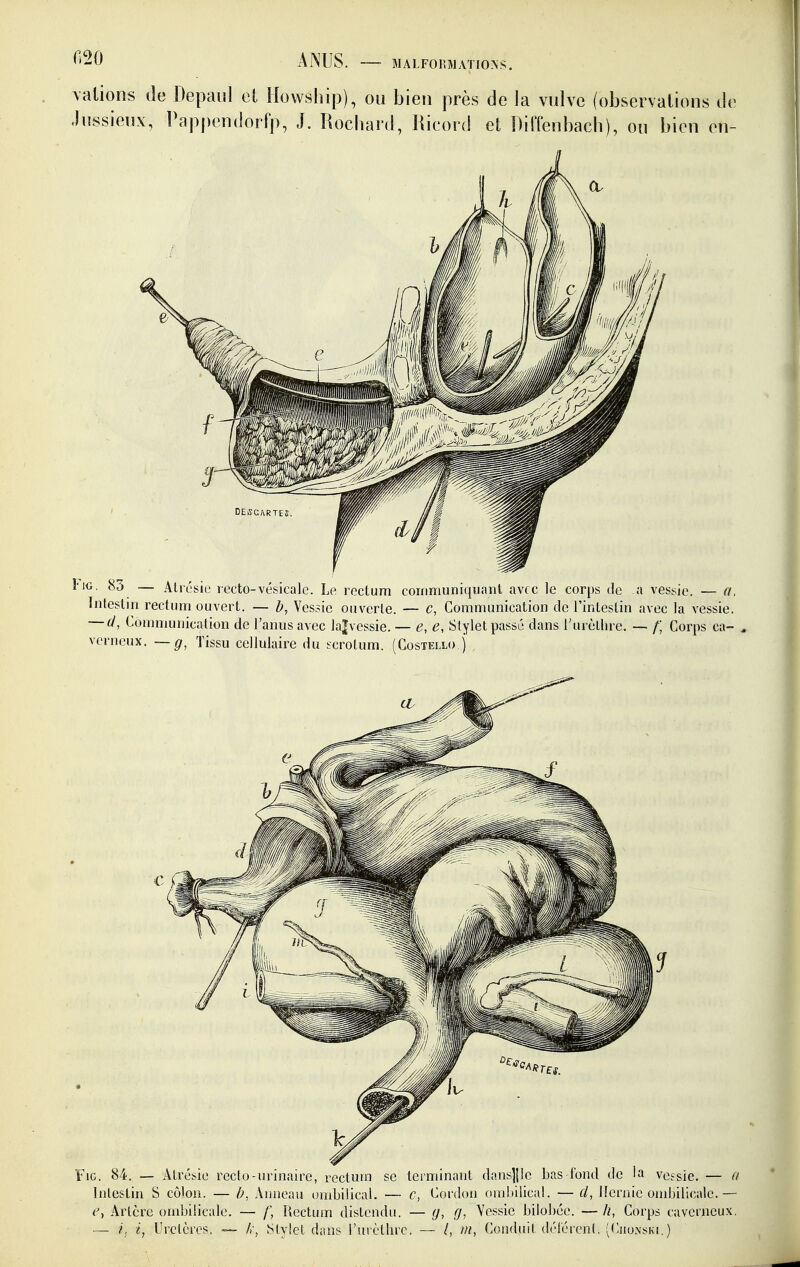 MALFOr.MATIOiN: \alions de Depaul et Howship), ou bien près de la vulve (observations d(> Jussieux, Pap|)endorfp, J. Rochard, Ricord el Diffenbach), ou bien en- î-iG. 85 — Ati'ésie recto-vésicale. Le rectum communiquant avec le corps de a vessie. — a. Intestin rectum ouvert. — b, Vessie ouverte. — c, Communication de l'intestin avec la vessie. — d, Communication de l'anus avec la|vessie. — e, e, Stylet passé dans l'urèlhre, — /; Corps ca- verneux. — g. Tissu cellulaire du ecrotum. (Costeixo j FiG. 84. — Atrésie recto-nrinaire, rectum se terminant dans]|]e bas-fond de la vessie. — o Intestin S côlon. — b, Anneau ombilical. — c, Cordon ombilical. — cl, Hernie ombilicale.— (^ Arlcre ombilicale. — Rectum distendu. — (j, g. Vessie bilobéc. — li, Corps caverneux. — i; ■(, Urclères. — /,■, Stylet dans l'urcthrc. — /, m, Conduit déiércnt, (Chonski.)