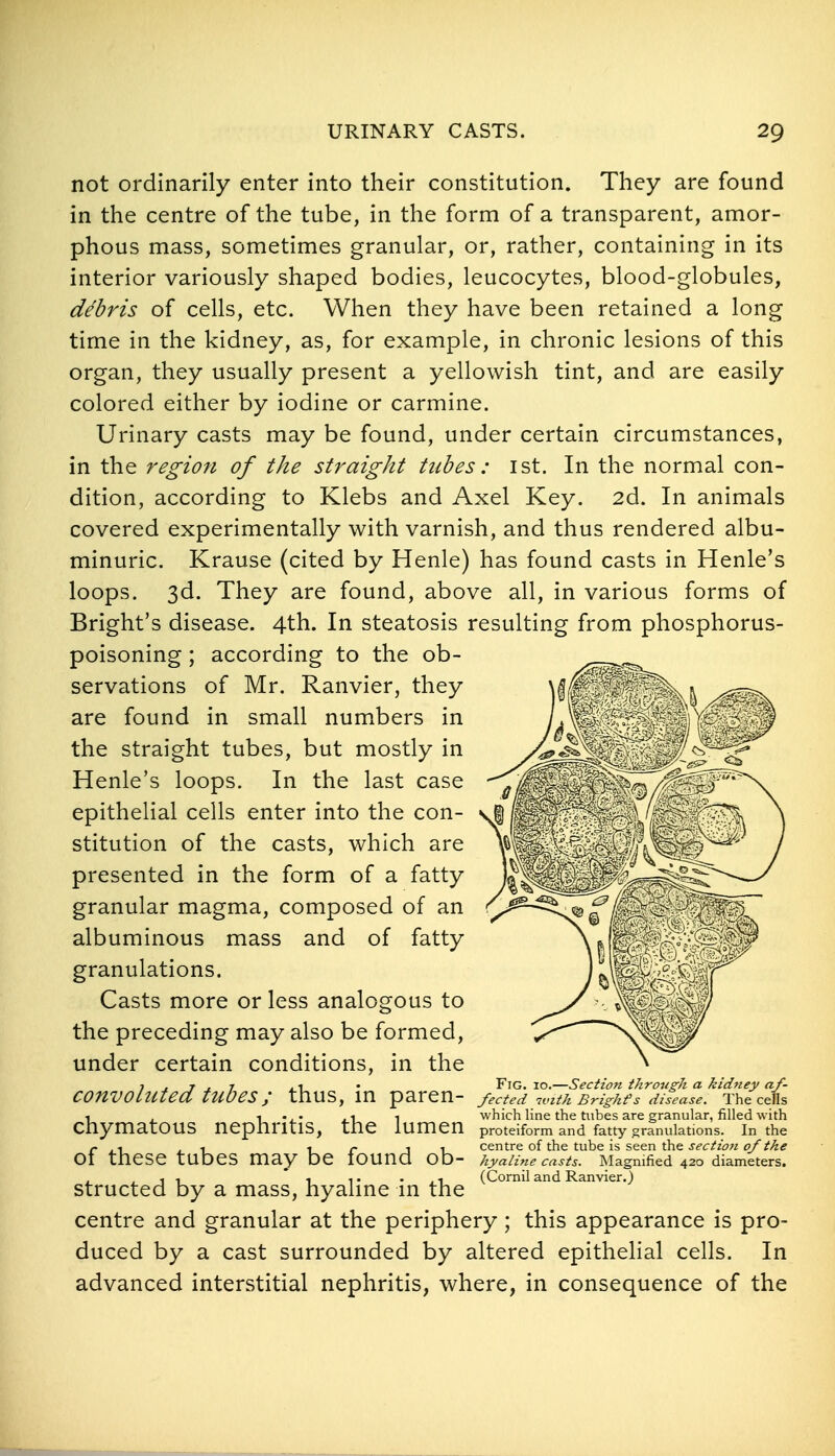 not ordinarily enter into their constitution. They are found in the centre of the tube, in the form of a transparent, amor- phous mass, sometimes granular, or, rather, containing in its interior variously shaped bodies, leucocytes, blood-globules, debris of cells, etc. When they have been retained a long time in the kidney, as, for example, in chronic lesions of this organ, they usually present a yellowish tint, and are easily colored either by iodine or carmine. Urinary casts may be found, under certain circumstances, in the region of the straight tubes : 1st. In the normal con- dition, according to Klebs and Axel Key. 2d. In animals covered experimentally with varnish, and thus rendered albu- minuric. Krause (cited by Henle) has found casts in Henle's loops. 3d. They are found, above all, in various forms of Bright's disease. 4th. In steatosis resulting from phosphorus- poisoning ; according to the ob- servations of Mr, Ranvier, they are found in small numbers in the straight tubes, but mostly in Henle's loops. In the last case epithelial cells enter into the con- stitution of the casts, which are presented in the form of a fatty granular magma, composed of an albuminous mass and of fatty granulations. Casts more or less analogous to the preceding may also be formed, under certain conditions, in the convohited tzibes; thus, in paren- chymatous nephritis, the lumen of these tubes may be found ob- structed by a mass, hyaline in the centre and granular at the periphery; this appearance is pro- duced by a cast surrounded by altered epithelial cells. In advanced interstitial nephritis, where, in consequence of the Fig. 10.—Section through a kidney af- fected 7tnth Brighfs disease. The cells which line the tubes are granular, filled with proteiform and fatty granulations. In the centre of the tube is seen the sectiofi of the hyaline casts. Magnified 420 diameters. (Cornil and Ranvier.)