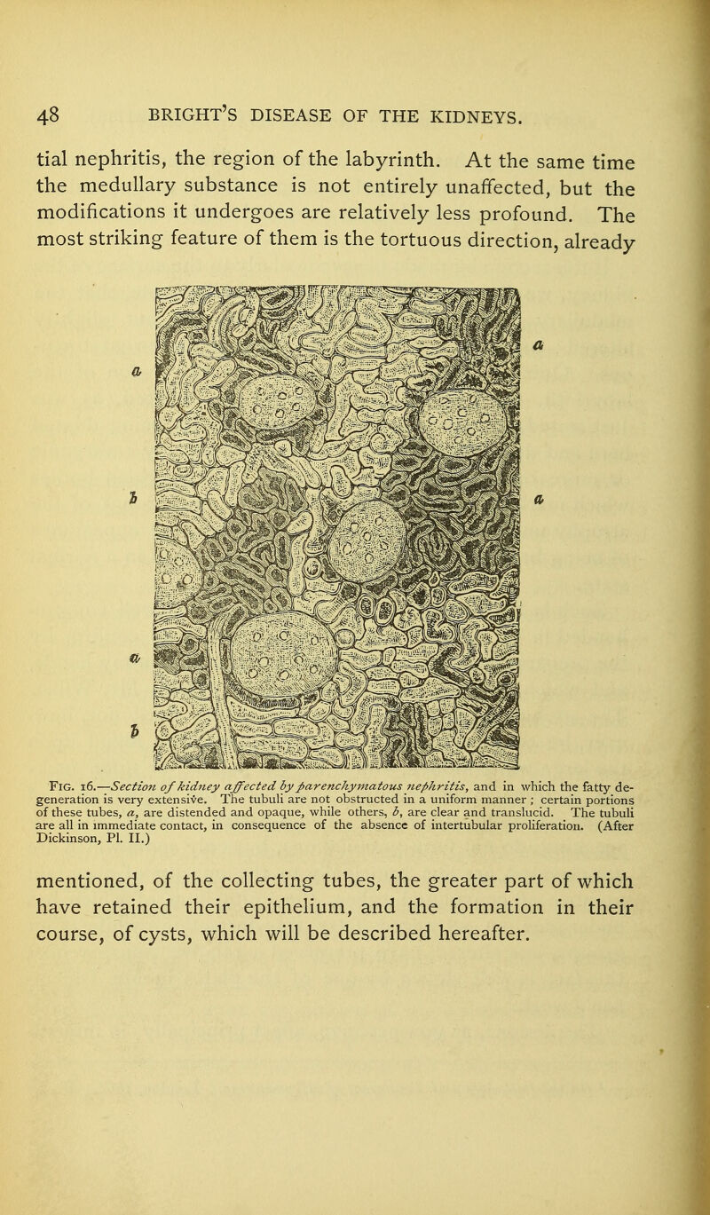 tial nephritis, the region of the labyrinth. At the same time the medullary substance is not entirely unaffected, but the modifications it undergoes are relatively less profound. The most striking feature of them is the tortuous direction, already Fig. i6.—Section of kidney affected by ;parenchymatous nephritis, and in which the fatty de- generation is very extensive. The tubuli are not obstructed in a uniform manner ; certain portions of these tubes, a, are distended and opaque, while others, b, are clear and translucid. The tubuli are all in immediate contact, in consequence of the absence of intertubular proliferation. (After Dickinson, PI. II.) mentioned, of the collecting tubes, the greater part of which have retained their epithehum, and the formation in their course, of cysts, which will be described hereafter.