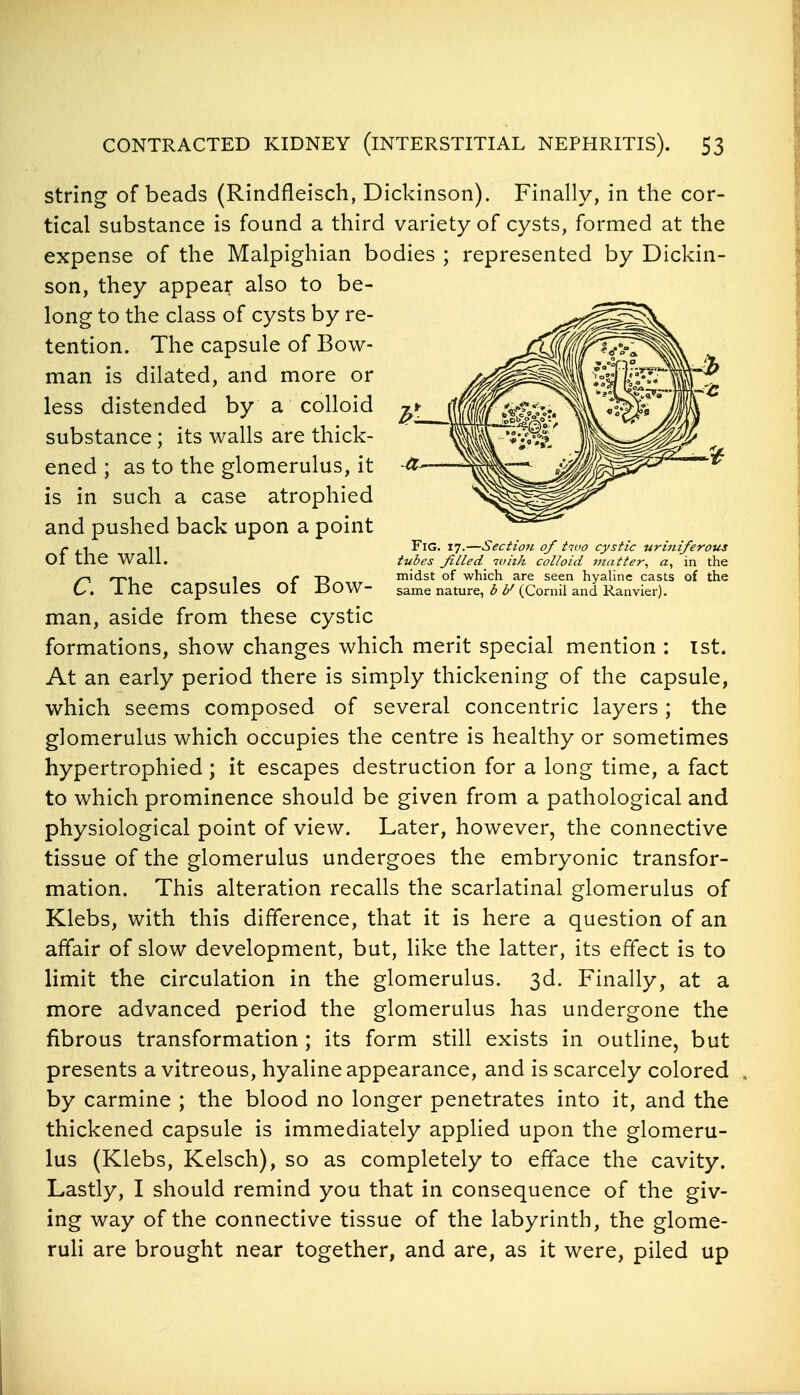 string of beads (Rindfleisch, Dickinson). Finally, in the cor- tical substance is found a third variety of cysts, formed at the expense of the Malpighian bodies ; represented by Dickin- son, they appear also to be- long to the class of cysts by re- tention. The capsule of Bow- man is dilated, and more or less distended by a colloid substance; its walls are thick- ened ; as to the glomerulus, it is in such a case atrophied and pushed back upon a point of the wall. C. The capsules of Bow- man, aside from these cystic formations, show changes which merit special mention : 1st. At an early period there is simply thickening of the capsule, which seems composed of several concentric layers; the glomerulus which occupies the centre is healthy or sometimes hypertrophied; it escapes destruction for a long time, a fact to which prominence should be given from a pathological and physiological point of view. Later, however, the connective tissue of the glomerulus undergoes the embryonic transfor- mation. This alteration recalls the scarlatinal glomerulus of Klebs, with this difference, that it is here a question of an affair of slow development, but, like the latter, its effect is to limit the circulation in the glomerulus. 3d. Finally, at a more advanced period the glomerulus has undergone the fibrous transformation ; its form still exists in outline, but presents a vitreous, hyaline appearance, and is scarcely colored by carmine ; the blood no longer penetrates into it, and the thickened capsule is immediately applied upon the glomeru- lus (Klebs, Kelsch), so as completely to efface the cavity. Lastly, I should remind you that in consequence of the giv- ing way of the connective tissue of the labyrinth, the glome- ruH are brought near together, and are, as it were, piled up Fig. 17.—Section of tivo cystic uriniferous tubes filled_ with colloid utatter, a, in the midst of which are seen hyaHne casts of the same nature, b V (Cornil and Ranvier).