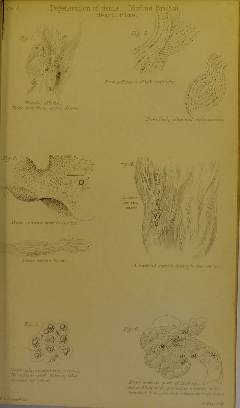 i'tissue. Morbus Pri'^h+ii Hesu't-fibre. IfacvUay aXbrda^'. Thick- spot frorto exocarcUnnu. ■■■■Til': • JFivn-L fleshy cxiUimn of r^jqJit cuirichi-: I'ronv i7pajjite> spot in. cun-taJ. Irhtter serous coai/. Fui. tabes •