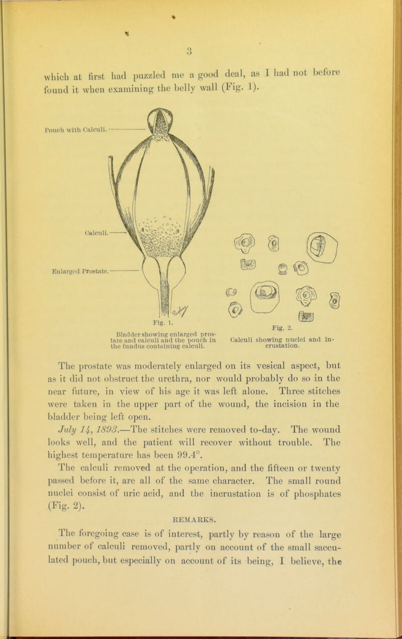 which at iirst had puzzled me a good deal, as 1 had not before found it when examining the belly wall (Fig. 1). Bladder showing enlarged pros- tate and calculi and the pouch in Calculi showing nuclei and in- the fundus containing calculi. crustation. The prostate was moderately enlarged on its vesical aspect, but as it did not obstruct the urethra, nor would probably do so in the near future, in view of his age it was left alone. Three stitches were taken iu the upper part of the wound, the incision in the bladder being left open. July llf., 1893.—The stitches were removed to-day. The wound looks well, and the patient will recover without trouble. The highest temperature has been 99.4°. The calculi removed at the operation, and the fifteen or twenty passed before it, are all of the same character. The small round nuclei consist of uric acid, and the incrustation is of phosphates (Fig. 2). REMARKS. The foregoing case is of interest, partly by reason of the large number of calculi removed, partly on account of the small saccu- lated pouch, but especially on account of its being, I believe, the