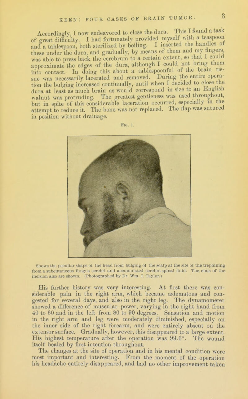 Accordingly, I now endeavored to close the dura. This I found a task of great difficulty. I had fortunately provided myself with a teaspoon and a tablespoon, both sterilized by boiling. I inserted the handles ot these under the dura, and gradually, by means of them and my lingers, was able to press back the cerebrum to a certain extent, so that 1 could approximate the edges of the dura, although 1 could not bring them into contact. In doing this about a tablespoonful of the brain tis- sue was necessarily lacerated and removed. During the entire opera- tion the bulging increased continually, until when I decided to close the dura at least as much brain as would correspond in size to an English walnut was protruding. The greatest gentleness was used throughout, but in spite of this considerable laceration occurred, especially in the attempt to reduce it. The bone was not replaced. The flap was sutured in position without drainage. Fig. 1. Shows the peculiar shape ol the head from bulging ol the scalp at the site ot the trephining from a subcutaneous fungus cerebri and accumulated cerebro-spinal fluid. The ends of the incision also are shown. (Photographed by Dr. Wm. J. Taylor.) His further history was very interesting. At first there was con- siderable pain in the right arm, which became oedematous and con- gested for several days, and also in the right leg. The dynamometer showed a difference of muscular power, varying in the right hand from 40 to 60 and in the left from 80 to 90 degrees. Sensation and motion in the right arm and leg were moderately diminished, especially on the inner side of the right forearm, and were entirely absent on the extensor surface. Gradually, however, this disappeared to a large extent. His highest temperature after the operation was 99.6°. The wound itself healed by first intention throughout. The changes at the site of operation and in his mental condition were most important and interesting. From the moment of the operation his headache entirely disappeared, and had no other improvement taken