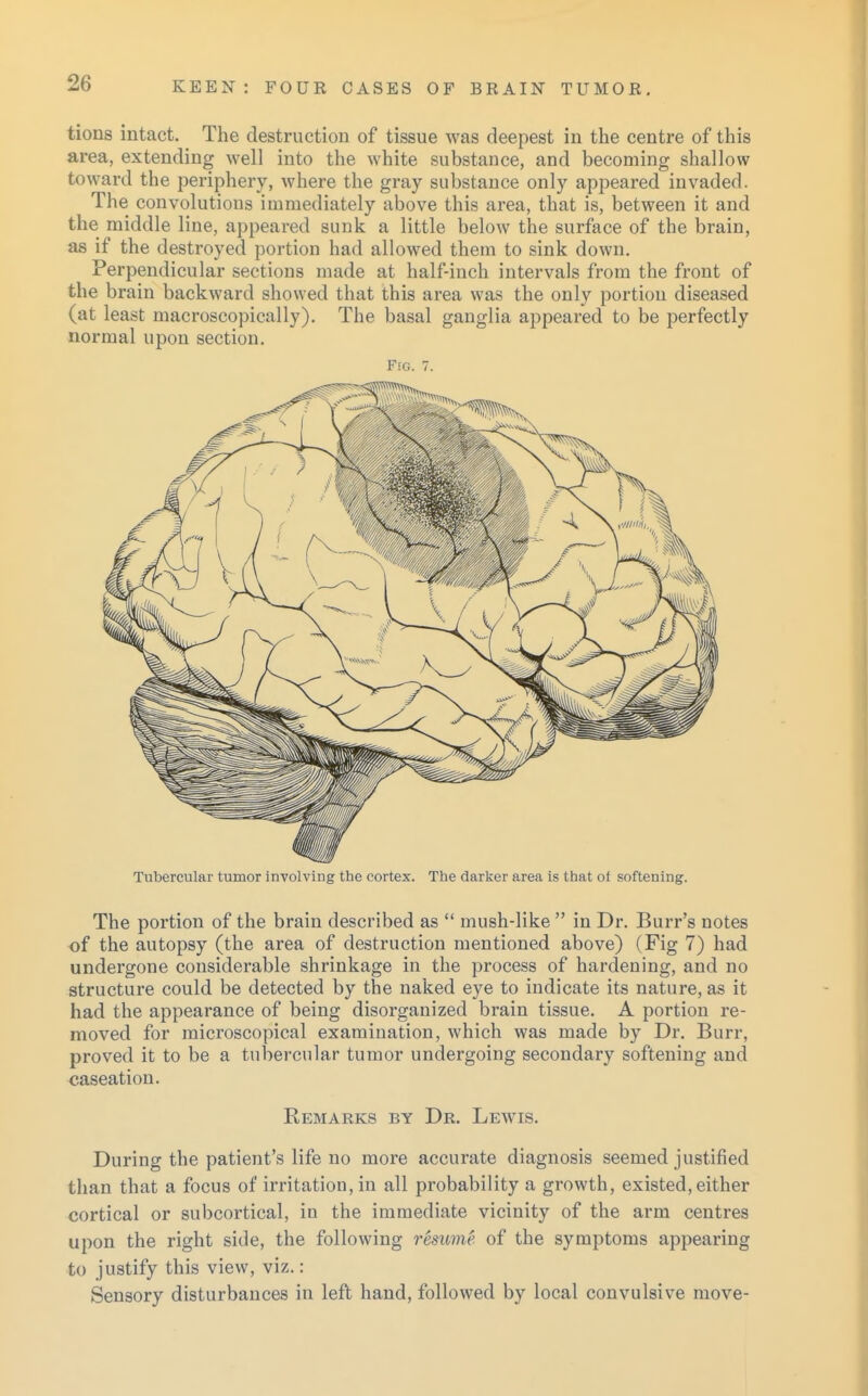 tions intact. The destruction of tissue was deepest in the centre of this area, extending well into the white substance, and becoming shallow toward the periphery, where the gray substance only appeared invaded. The convolutions immediately above this area, that is, between it and the middle line, appeared sunk a little below the surface of the brain, as if the destroyed portion had allowed them to sink down. Perpendicular sections made at half-inch intervals from the front of the brain backward showed that this area was the only portion diseased (at least macroscopically). The basal ganglia appeared to be perfectly normal upon section. Fig. 7. Tubercular tumor involving the cortex. The darker area is that of softening. The portion of the brain described as  mush-like  in Dr. Burr's notes of the autopsy (the area of destruction mentioned above) (Fig 7) had undergone considerable shrinkage in the process of hardening, and no structure could be detected by the naked eye to indicate its nature, as it had the appearance of being disorganized brain tissue. A portion re- moved for microscopical examination, which was made by Dr. Burr, proved it to be a tubercular tumor undergoing secondary softening and caseation. Remarks by Dr. Lewis. During the patient's life no more accurate diagnosis seemed justified than that a focus of irritation, in all probability a growth, existed, either cortical or subcortical, in the immediate vicinity of the arm centres upon the right side, the following resume of the symptoms appearing to justify this view, viz.: Sensory disturbances in left hand, followed by local convulsive move-