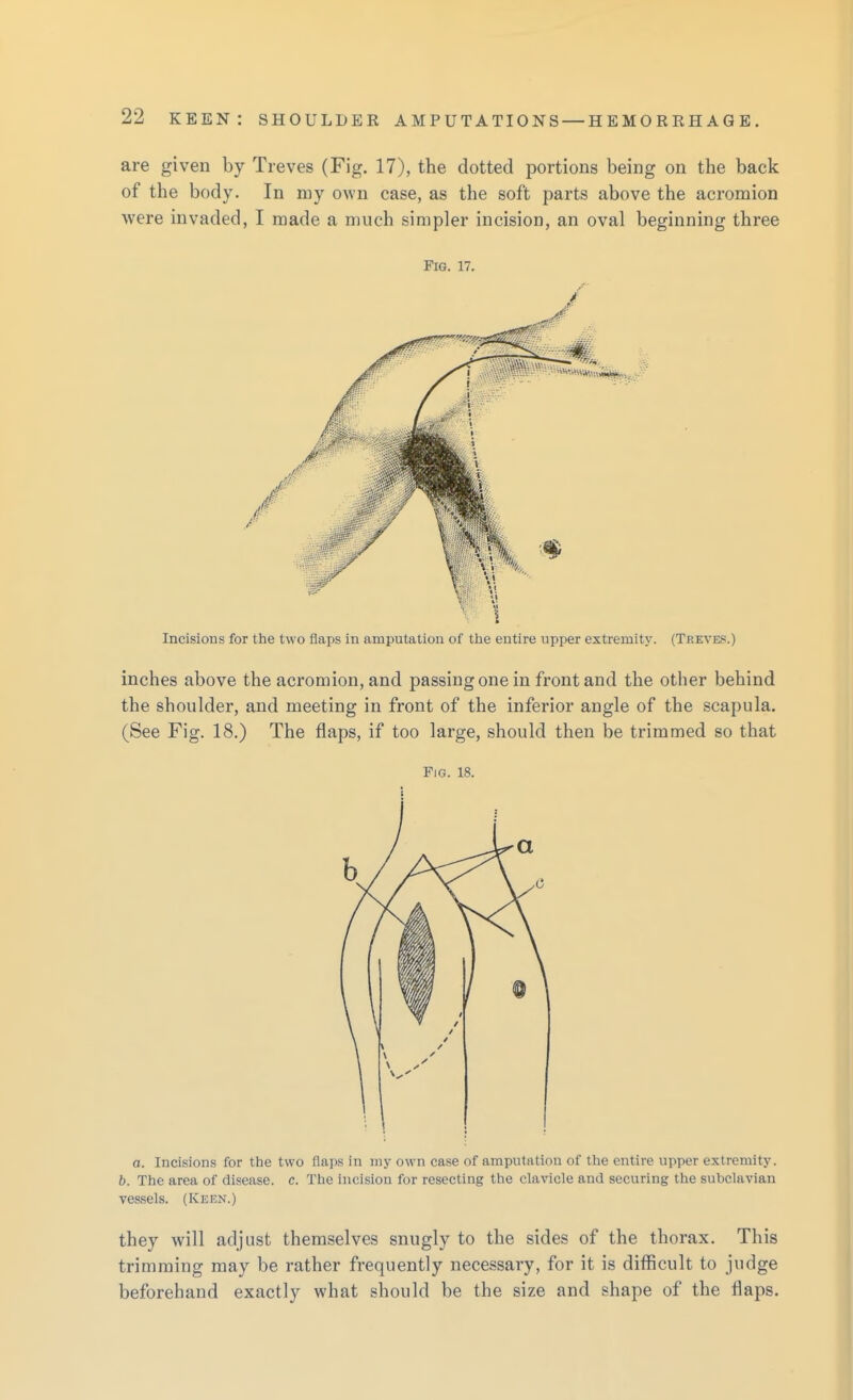 are given by Treves (Fig. 17), the dotted portions being on the back of the body. In my own case, as the soft parts above the acromion were invaded, I made a much simpler incision, an oval beginning three Fig. 17. Incisions for the two flaps in amputation of the entire upper extremity. (Treves.) inches above the acromion, and passing one in front and the other behind the shoulder, and meeting in front of the inferior angle of the scapula. (See Fig. 18.) The flaps, if too large, should then be trimmed so that Fig. 18. a. Incisions for the two flaps in my own case of amputation of the entire upper extremity. 5. The area of disease, c. The incision for resecting the clavicle and securing the subclavian vessels. (Keen.) they will adjust themselves snugly to the sides of the thorax. This trimming may be rather frequently necessary, for it is difficult to judge beforehand exactly what should be the size and shape of the flaps.