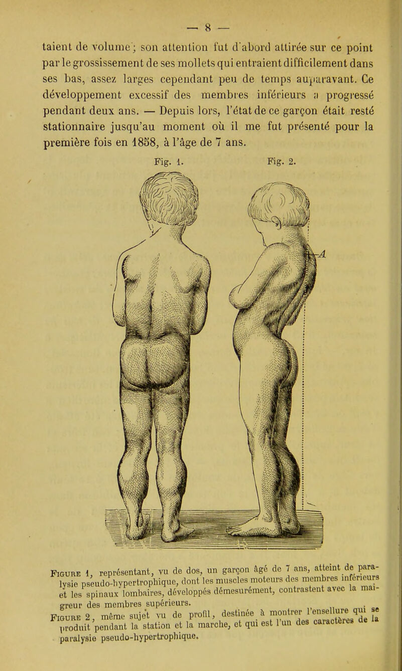 taient de volume ; son attention fut dabord attirée sur ce point par le grossissement de ses mollets qui entraient difficilement dans ses bas, assez larges cependant peu de temps auparavant. Ce développement excessif des membres inférieurs :i progressé pendant deux ans. — Depuis lors, l'état de ce garçon était resté stationnaire jusqu'au moment où il me fut présenté pour la première fois en 18S8, à l'âge de 7 ans. Fig. 1. Figure l, représentant, vu de dos, un garçon âge de 7 ans, atteint de para- lysie pséudo-hYportrophique, dont les muscles moteurs des membres inférieurs et les spinaux'lombaires, développés démesurément, contrastent avec la mai- greur des membres supérieurs. . „ • Figure 2 même sujet vu de profil, destinée à montrer 1 ensellure qui « ToduH'pendant lactation et lï marche, et qui est l'un des caractère» de la paralysie pseudo-hypertroplùque.