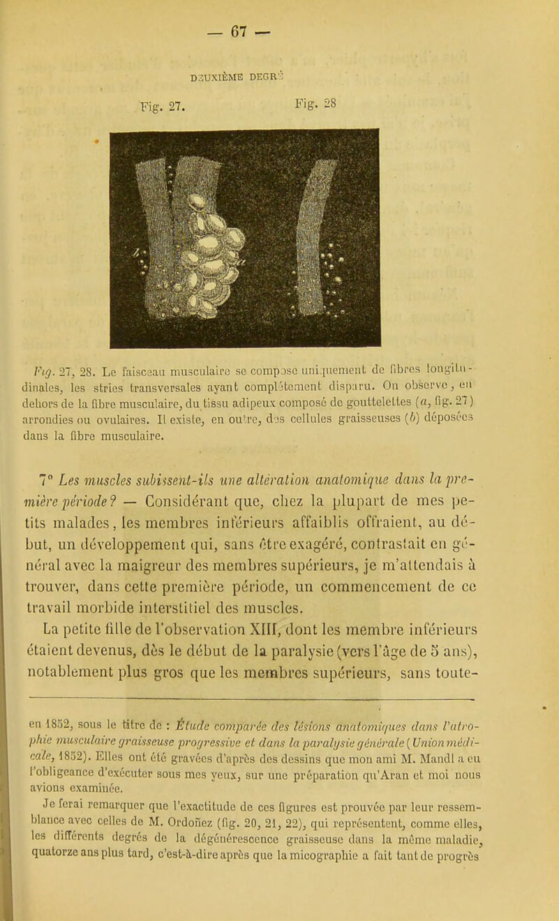 DEUXIÈME DEGR'C Fig. 27. F'ff- ^8 Fig. 21, 28. Le faiscaaii musculaire se compose iitii.iuenient de fibres tong'ilii- diiiales, les stries transversales ayant compljtoment disparu. On observe, eu dehors de la fibre musculaire, du tissu adipeux composé de gouttelettes («, fig. 27) arrondies ou ovulaires. Il existe, en oulre, d js cellules graisseuses {h) déposées dans la fibre musculaire. 7 Les muscles suhhsent-ils une altération analomique dans la pre- mière période ? — Considérant que, chez la plupart de mes pe- tits malades, les membres inférieurs affaiblis offraient, au dé- but, un développement qui, sans ôtre exagéré, contrasiait en gé- néral avec la maigreur des membres supérieurs, je m'attendais à trouver, dans cette première période, un commencement de ce travail morbide interstitiel des muscles. La petite fille de l'observation Xill, dont les membre inférieurs étaient devenus, dès le début de la paralysie (vers l'âge de 5 ans), notablement plus gros que les membres supérieurs, sans toute- en 1832, sous le titre de : Étude comparée des lésions anatofitiques dans Vutro- p/na musculaire graisseuse progressive et dans la paralysie générale ( Union médi- cale, 1832). Elles ont été gravées d'après des dessins que mon ami M. Maudl a eu l'obligeance d'exécuter sous mes yeux, sur une préparation qu'Aran et moi nous avions examinée. Je ferai remarquer que l'exactitude de ces figures est prouvée par leur ressem- blance avec celles de M. Ordonez (fig. 20, 21, 22), qui représentent, comme elles, les difîérents degrés do la dégénérescence graisseuse dans la même maladie, quatorze ans plus tard, c'est-à-dire après que lamicograpliie a fait tant de progrès