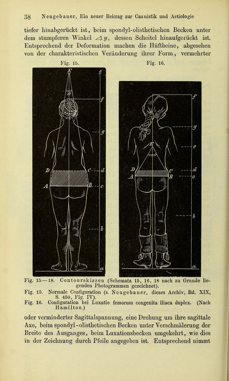 tiefer hinabgerückt ist, beim spondyl-olisthetischen Becken unter dem stumpferen Winkel dessen Scheitel liinaufgeriickt ist. Entsprechend der Deformation machen die Hüftbeine, abgesehen von der charakteristischen Veränderung ihrer Form, vermehrter Fig. 15. Fig. 16. Fig. 15—18. Contourskizzen (Schemata 15, 16, 18 nach zu Grunde lie- genden Photogrammen gezeichnet). Fig. 15. Normale Configuration (s. Neugebauer, dieses Archiv, Bd. XIX, S. 450, Fig. IV). Fig. 16. Configuration bei Luxatio femorum congenita iliaca duplex. (Nach Hamilton.) oder verminderter Sagittalspannung, eine Drehung um ihre sagittale Axe, beim spondyl - olisthetischen Becken unter Verschmälerung der Breite des Ausganges, beim Luxationsbecken umgekehrt, wie dies in der Zeichnung durch Pfeile angegeben ist. Entsprechend nimmt