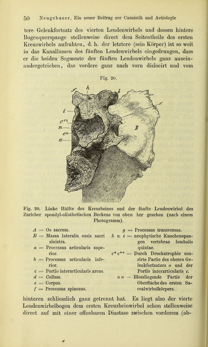 tere Gelenkfortsatz des vierten Lendenwirbels und dessen hintere Bogenquerspange stellenweise direct dem Seitentlieile des ersten Kreuzwirbels aufruhten, d. h. der letztere (sein Körper) ist so weit in das Kanallumen des fünften Lendenwirbels eingedrungen, dass er die beiden Segmente des fünften Lendenwirbels ganz ausein- andergetrieben, das vordere ganz nach vorn dislocirt und vom Fig. 20. Fig. 20. Linke Hälfte des Kreuzbeines und der fünfte Lendenwirbel des Züricher spondyl-olisthetiscben Beckens Von oben her gesehen (nach einem Photogramm). A = Os sacrum. B == Massa lateralis ossis sacri sinistra. a = Processus articularis supe- rior. b = Processus articularis infe- rior. c = Portio interarticularis arcus. d = Collum. e = Corpus. f = Processus spinosus. ff Ii u. i Processus transversus. neophytische Knochenspan- gen vertebrae lumbalis quintae. Durch Druckatrophie usu- rirte Partie des oberen Ge- lenkfortsatzes a und der Portio interarticularis c. Blossliegende Partie der Oberfläche des ersten Sa- cralwirbelkörpers. hinteren schliesslich ganz getrennt hat. Es liegt also der vierte Lendenwirbelbogen dem ersten Kreuzbeinwirbel schon stellenweise direct auf mit einer offenbaren Diastase zwischen vorderem (ab-