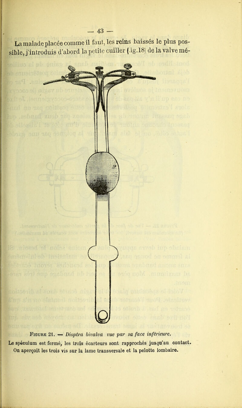 La malade placée comme il faut, les reins baissés le plus pos- sible J'introduis d'abord la petite cuiller (Ag.18) de la valve mé- Figure 21. «— Dioptra bivalva vue par sa face inférieure. Le spéculum est fermé, les trois écarteurs sont rapprochés jusqu'au contact. On aperçoit les trois vis sur la lame transversale et la pelotte lombaire.