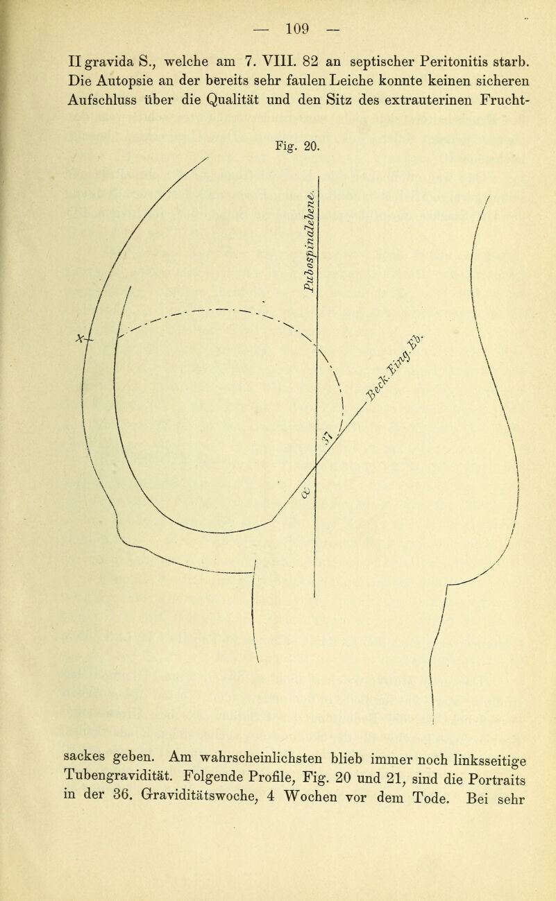 Ilgravida S., welche am 7. VIII. 82 an septischer Peritonitis starb. Die Autopsie an der bereits sehr faulen Leiche konnte keinen sicheren Aufschluss über die Qualität und den Sitz des extrauterinen Frucht- Fig. 20. t sackes geben. Am wahrscheinlichsten blieb immer noch linksseitige Tubengravidität. Folgende Profile, Fig. 20 und 21, sind die Portraits in der 36. Graviditätswoche, 4 Wochen vor dem Tode. Bei sehr