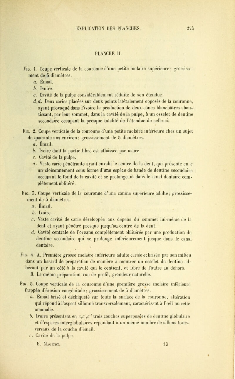 PLANCHE 11. FiG. 1. Coupe verticale de la couronne d'une petite molaire supérieure; grossisse- ment de 5 diamètres. a. Émail. b. Ivoire. c. Cavité de la pulpe considérablement réduite de son étendue. d. d. Deux caries placées sur deux points latéralement opposés de la couronne, ayant provoqué dans Fivoire la production de deux cônes blanchâtres abou- tissant, par leur sommet, dans la cavité de la pulpe, à un osselet de dentine secondaire occupant la presque totalité de Tétendue de celle-ci. FiG. 2. Coupe verticale de la couronne d'une petite molaire inférieure chez un sujet de quarante ans environ; grossissement de 5 diamètres. a. Émail. b. Ivoire dont la partie bbre est affaissée par usure. c. Cavité de la pulpe. d. Vaste carie pénétrante ayant envahi le centre de la dent, qui présente en e un cloisonnement sous forme d'une espèce de bande de dentine secondaire occupant le fond de la cavité et se prolongeant dans le canal dentaire com- plètement oblitéré. FiG. 0. Coupe verticale de la couronne d'une canine supérieure adulte; grossisse- ment de 5 diamètres. a. Émail. b. Ivoire. c. Vaste cavité de carie développée aux dépens du sommet lui-même de la dent et ayant pénétré presque jusqu'au centre de la dent. d. Cavité centrale de l'organe complètement obhtérée par une production de dentine secondaire qui se prolonge inférieurement jusque dans le canal dentaire. FiG. 4. A. Première grosse molaire inférieure adulte cariée et brisée par son milieu dans un hasard de préparation de manière à montrer un osselet de dentine ad- hérant par un côté à la cavité qui le contient, et libre de l'autre au dehors. B. La même préparation vue de profil, grandeur naturelle. FiG. 5. Coupe verticale de la couronne d'une première grosse molaire inférieure frappée d'érosion congénitale ; grossissement de 5 diamètres. a. Émail brisé et déchiqueté sur toute la surface de la couronne, altération qui répond à l'aspect sillonné transversalement, caractérisimt à Tœil nu cette anomahe. b. Ivoire présentant en c,c',c'' trois couches superposées de dentine globulaire et d'espaces interglobulaires répondant a un même nombre de sillons trans- versaux de la couche dYunail. r. Cavité de la pulpe. E. .M.vGrroT. 15