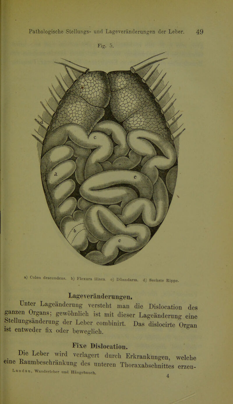 a) Colon descendcns. b) Flexura iliaca. c) Dünndarm, d) Sechste Rippe. Lageveräiideruugen. Unter Lageänderung versteht man die Dislocation des ganzen Organs; gewöhnlich ist mit dieser Lageänderung eine Stellungsänderung der Leber combinirt. Das dislocirte Organ ist entweder fix oder beweglich. Fixe Dislocation. Die Leber wird verlagert durch Erkrankungen, welche eine Raumbeschränkung des unteren Thoraxabschnittes erzeu- Landau, Wanderleber und Hängebauch.