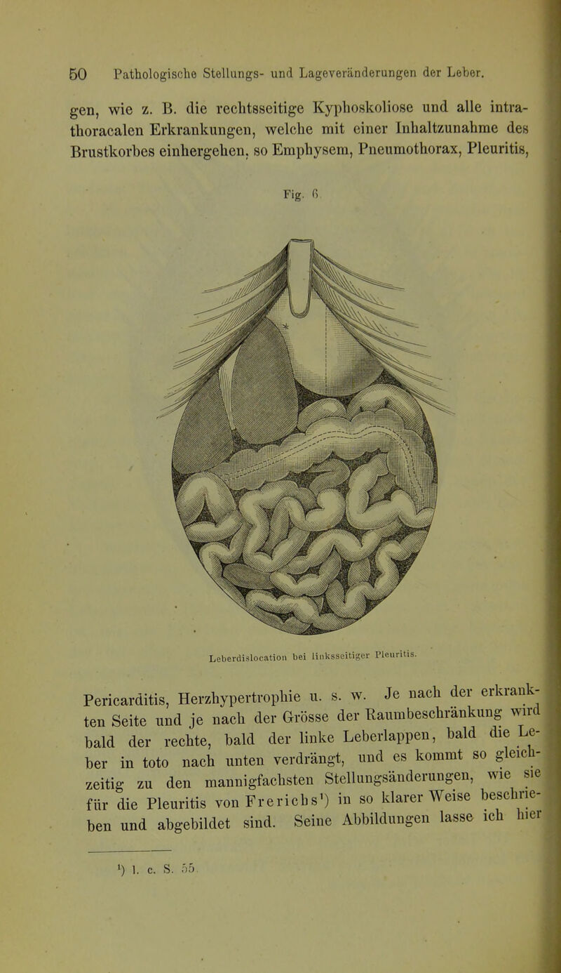 gen, wie z. B. die rechtsseitige Kyphoskoliose und alle intra- thoracalen Erkrankungen, welche mit einer Inhaltzunahme des Brustkorbes einhergehen, so Emphysem, Pneumothorax, Pleuritis, Fig. G Leberdislocation bei linksseitiger Pleuritis. Pericarditis, Herzhypertrophie u. s. w. Je nach der erkrank- ten Seite und je nach der Grösse der Raumbeschränkung wird bald der rechte, bald der linke Leberlappen, bald die Le- ber in toto nach unten verdrängt, und es kommt so gleich- zeitig zu den mannigfachsten Stellungsänderungen, wie sie für die Pleuritis von Frerichs') in so klarer Weise beschrie- ben und abgebildet sind. Seine Abbildungen lasse ich hiei 0 1. c. S. Ö5.