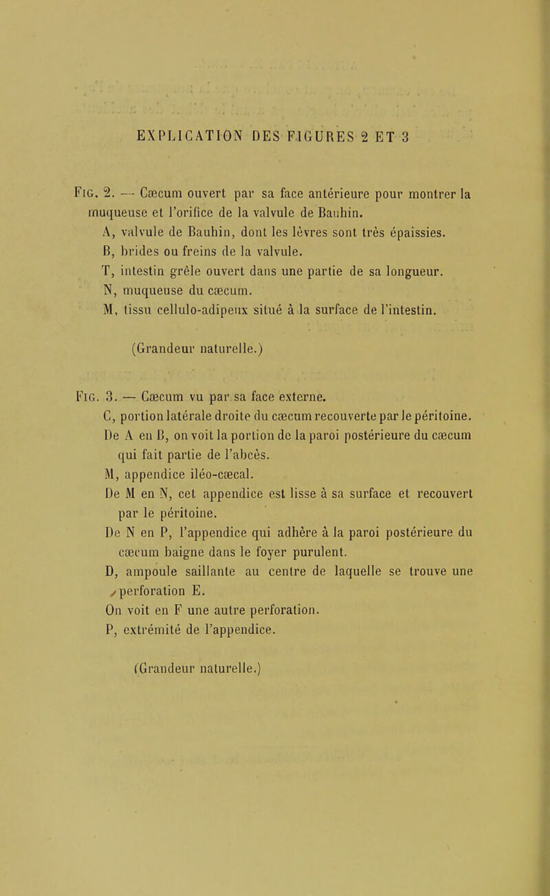 FiG. 2. — Ccecum ouvert par sa face antérieure pour montrer la muqueuse et l'orifice de la valvule de Bauhin. A, valvule de Bauhin, dont les lèvres sont très épaissies. B, brides ou freins de la valvule. T, intestin grêle ouvert dans une partie de sa longueur. N, muqueuse du cœcum. M, tissu cellulo-adipeux situé à la surface de l'intestin. (Grandeur naturelle.) FiG. 3. — Caecum vu par sa face externe. C, portion latérale droite du caecum recouverte par le péritoine. De A en B, on voit la portion de la paroi postérieure du caecum qui fait partie de l'abcès. M, appendice iléo-cœcal. De M en N, cet appendice est lisse à sa surface et recouvert par le péritoine. De N en P, l'appendice qui adhère à la paroi postérieure du caecum baigne dans le foyer purulent. D, ampoule saillante au centre de laquelle se trouve une /perforation E. On voit en F une autre perforation. P, extrémité de l'appendice. (Grandeur naturelle.)