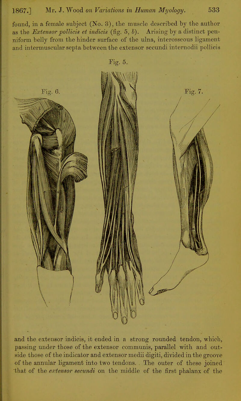 found, in a female subject (No. 3), the muscle described by the author as the Extensor pollicis et indicis (fig. 5, b). Arisiug by a distinct peu- niform belly from the hinder surface of the ulna, interosseous ligament and intermuscular septa between the extensor secundi internodii poUicis Kg. 5. and the extensor indicis, it ended in a strong rounded tendon, which, passing under those of the extensor communis, parallel with and out- side those of the indicator and extensor medii digiti, divided in the groove of the annular ligament into two tendons. , The outer of these joined that of the extensor secundi on the middle of the first phalanx of the