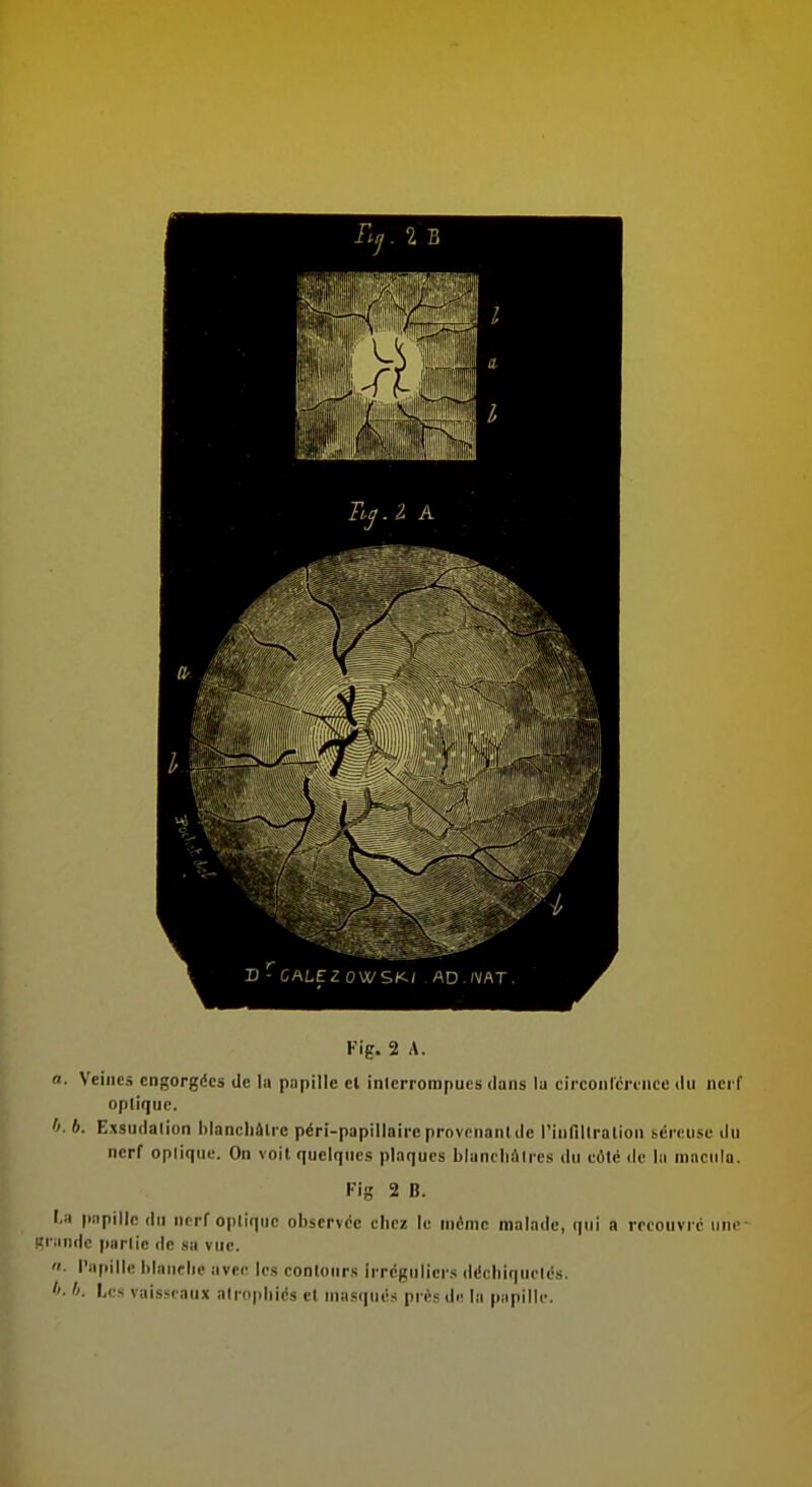 D ^CAL£:ZOWS/<; AD.IVAT r Fig. 2 A. a. Veilles engorgées de la papille el interrompues dans la circonlcroiice du nerf optique. 6. Exsudation liiancliâlrc péri-papillaire provenant de rinfiUralion séreuse du nerf optique. On volt quelques plaques blancliâtrcs du eôlé de lu mnciila. Fig 2 B. I.ii p:ipille du iicrf optique observée chez le même malade, qui a recouvre iine- WiMiidc partie de sa vue. • l'ii[iillc l)lanf lie avec les contours irrcguliei s déchiquetés. Les vaissiaux atrojdiiés el masqués pn-sd.' In pupille.