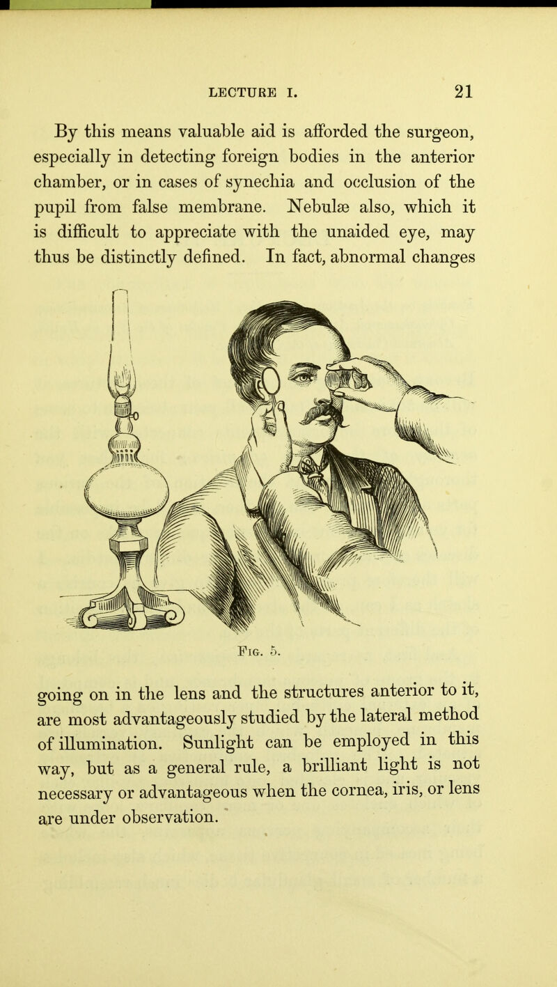 By this means valuable aid is afforded the surgeon, especially in detecting foreign bodies in the anterior chamber, or in cases of synechia and occlusion of the pupil from false membrane. Nebula? also, which it is difficult to appreciate with the unaided eye, may thus be distinctly denned. In fact, abnormal changes Fig. 5. going on in the lens and the structures anterior to it, are most advantageously studied by the lateral method of illumination. Sunlight can be employed in this way, but as a general rule, a brilliant light is not necessary or advantageous when the cornea, iris, or lens are under observation.