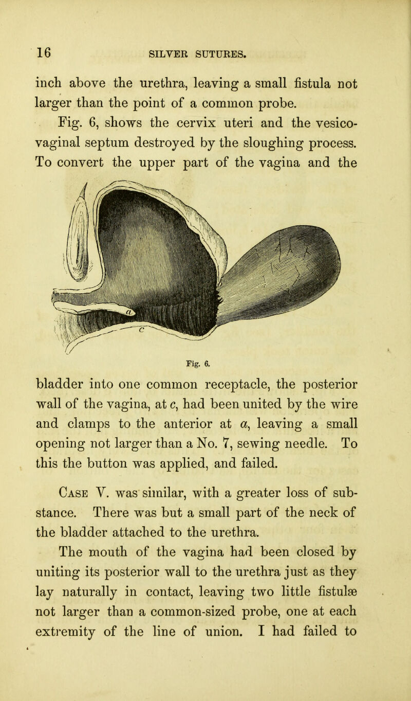 inch above the urethra, leaving a small fistula not larger than the point of a common probe. Fig. 6, shows the cervix uteri and the vesico- vaginal septum destroyed by the sloughing process. To convert the upper part of the vagina and the Fig. 6. bladder into one common receptacle, the posterior wall of the vagina, at c, had been united by the wire and clamps to the anterior at a, leaving a small opening not larger than a No. 7, sewing needle. To this the button was applied, and failed. Case Y. was similar, with a greater loss of sub- stance. There was but a small part of the neck of the bladder attached to the urethra. The mouth of the vagina had been closed by uniting its posterior wall to the urethra just as they lay naturally in contact, leaving two little fistulse not larger than a common-sized probe, one at each extremity of the line of union. I had failed to