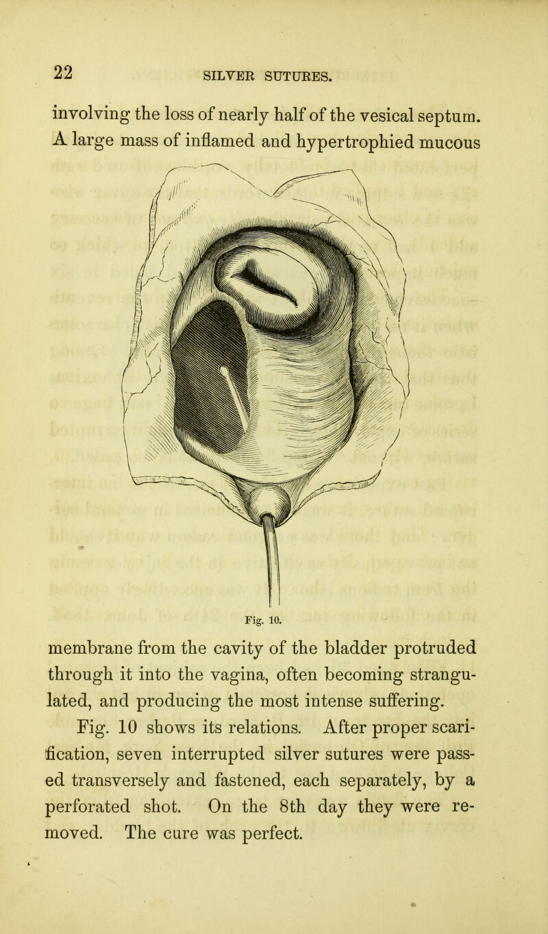 involving the loss of nearly half of the vesical septum. A large mass of inflamed and hypertrophied mucous Fig. 10. membrane from the cavity of the bladder protruded through it into the vagina, often becoming strangu- lated, and producing the most intense suffering. Fig. 10 shows its relations. After proper scari- fication, seven interrupted silver sutures were pass- ed transversely and fastened, each separately, by a perforated shot. On the 8th day they were re- moved. The cure was perfect.