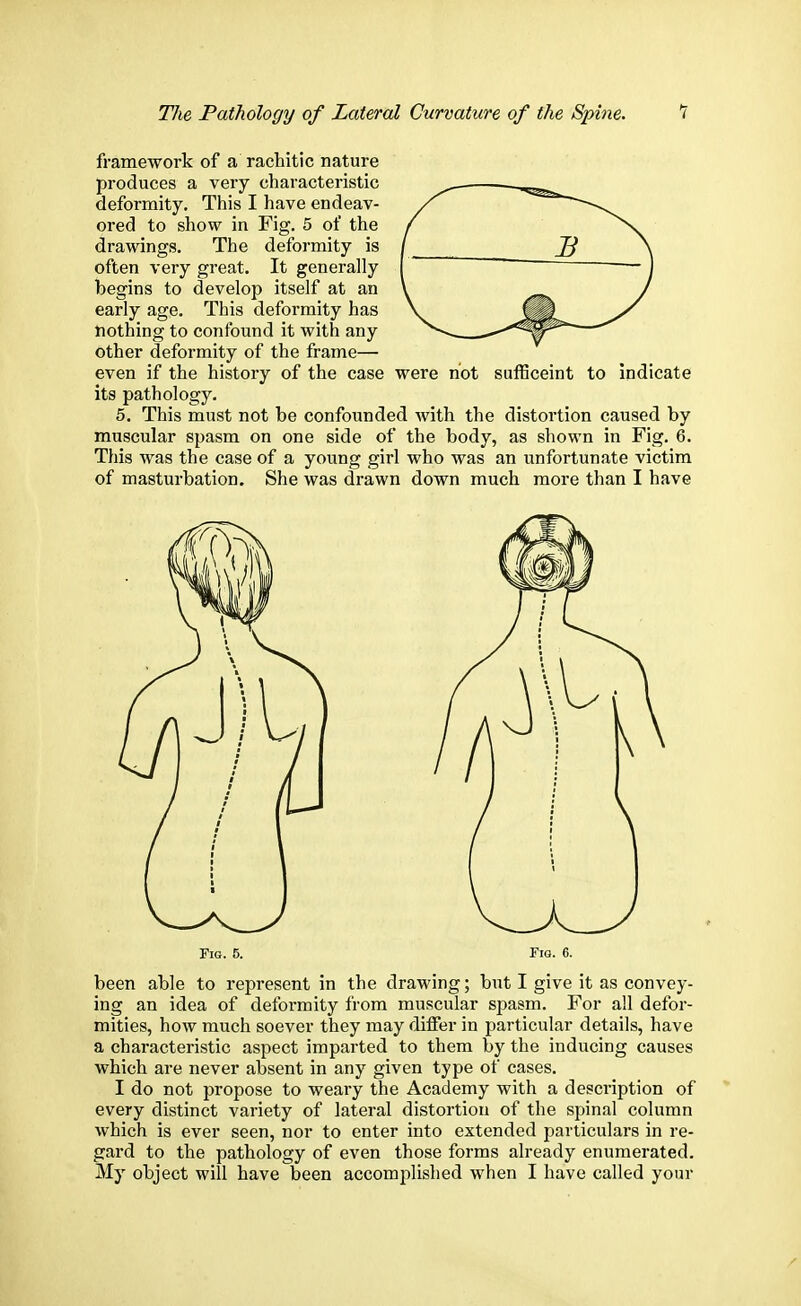 framework of a rachitic nature produces a very characteristic deformity. This I have endeav- ored to show in Fig. 5 of the drawings. The deformity is often very great. It generally begins to develop itself at an early age. This deformity has nothing to confound it with any other deformity of the frame— even if the history of the case were not sufficeint to indicate its pathology. 5. This must not be confounded Avith the distortion caused by muscular spasm on one side of the body, as shown in Fig. 6. This was the case of a young girl who was an unfortunate victim of masturbation. She was drawn down much more than I have Fig. 5. Fig. 6. been able to represent in the drawing; but I give it as convey- ing an idea of deformity from muscular spasm. For all defor- mities, how much soever they may differ in particular details, have a characteristic aspect imparted to them by the inducing causes which are never absent in any given type of cases. I do not propose to weary the Academy with a description of every distinct variety of lateral distortion of the spinal column which is ever seen, nor to enter into extended particulars in re- gard to the pathology of even those forms already enumerated. My object will have been accomplished when I have called your