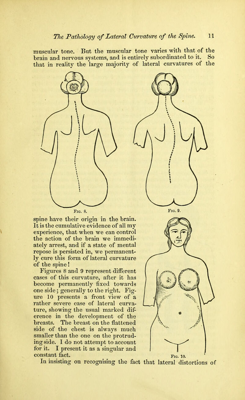 muscular tone. But the muscular tone varies with that of the brain and nervous systems, and is entirely subordinated to it. So that in reality the large majority of lateral curvatures of the Fig. 8. spine have their origin in the brain. It is the cumulative evidence of all my experience, that when we can control the action of the brain we immedi- ately arrest, and if a state of mental repose is persisted in, we permanent- ly cure this form of lateral curvature of the spine! Figures 8 and 9 represent different cases of this curvature, after it has become permanently fixed towards one side; generally to the right. Fig- ure 10 presents a front view of a rather severe case of lateral curva- ture, showing the usual marked diff- erence in the development of the breasts. The breast on the flattened side of the chest is always much smaller than the one on the protrud- ing side. I do not attempt to account for it. I present it as a singular and constant fact. In insisting on recognising the fact Fig. 10. that lateral distortions of