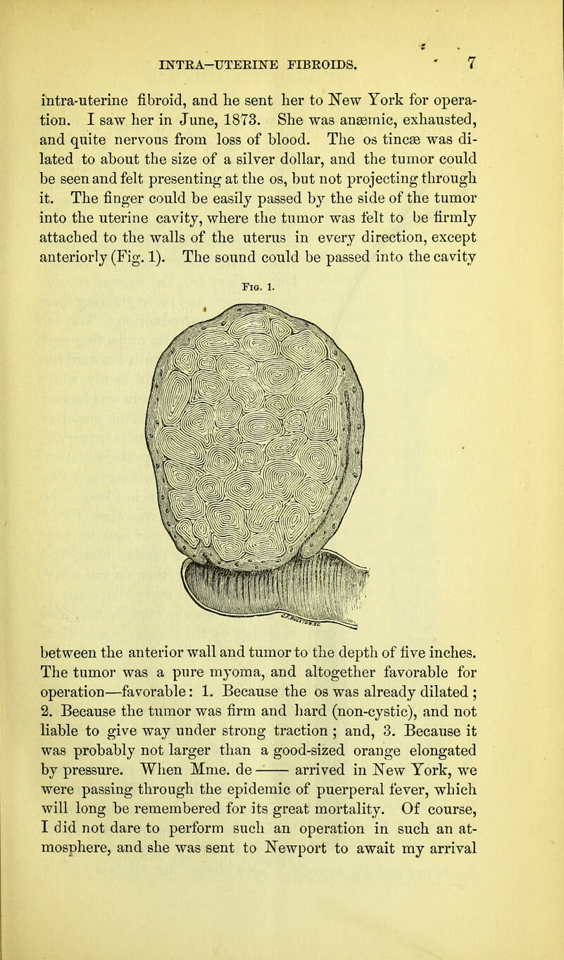 intra-uterine fibroid, and lie sent her to 'New York for opera- tion. I saw her in June, 1873. She was anaemic, exhausted, and quite nervous from loss of blood. The os tincse was di- lated to about the size of a silver dollar, and the tumor could be seen and felt presenting at the os, but not projecting through it. The finger could be easily passed by the side of the tumor into the uterine cavity, where the tumor was felt to be firmly attached to the walls of the uterus in every direction, except anteriorly (Fig. 1). The sound could be passed into the cavity Fig. 1. between the anterior wall and tumor to the depth of five inches. The tumor was a pure myoma, and altogether favorable for operation—favorable: 1. Because the os was already dilated ; 2. Because the tumor was firm and hard (non-cystic), and not liable to give way under strong traction ; and, 3. Because it was probably not larger than a good-sized orange elongated by pressure. When Mme. de arrived in ISTew York, we were passing through the epidemic of puerperal fever, which will long be remembered for its great mortality. Of course, I did not dare to perform such an operation in such an at- mosphere, and she was sent to Kewport to await my arrival