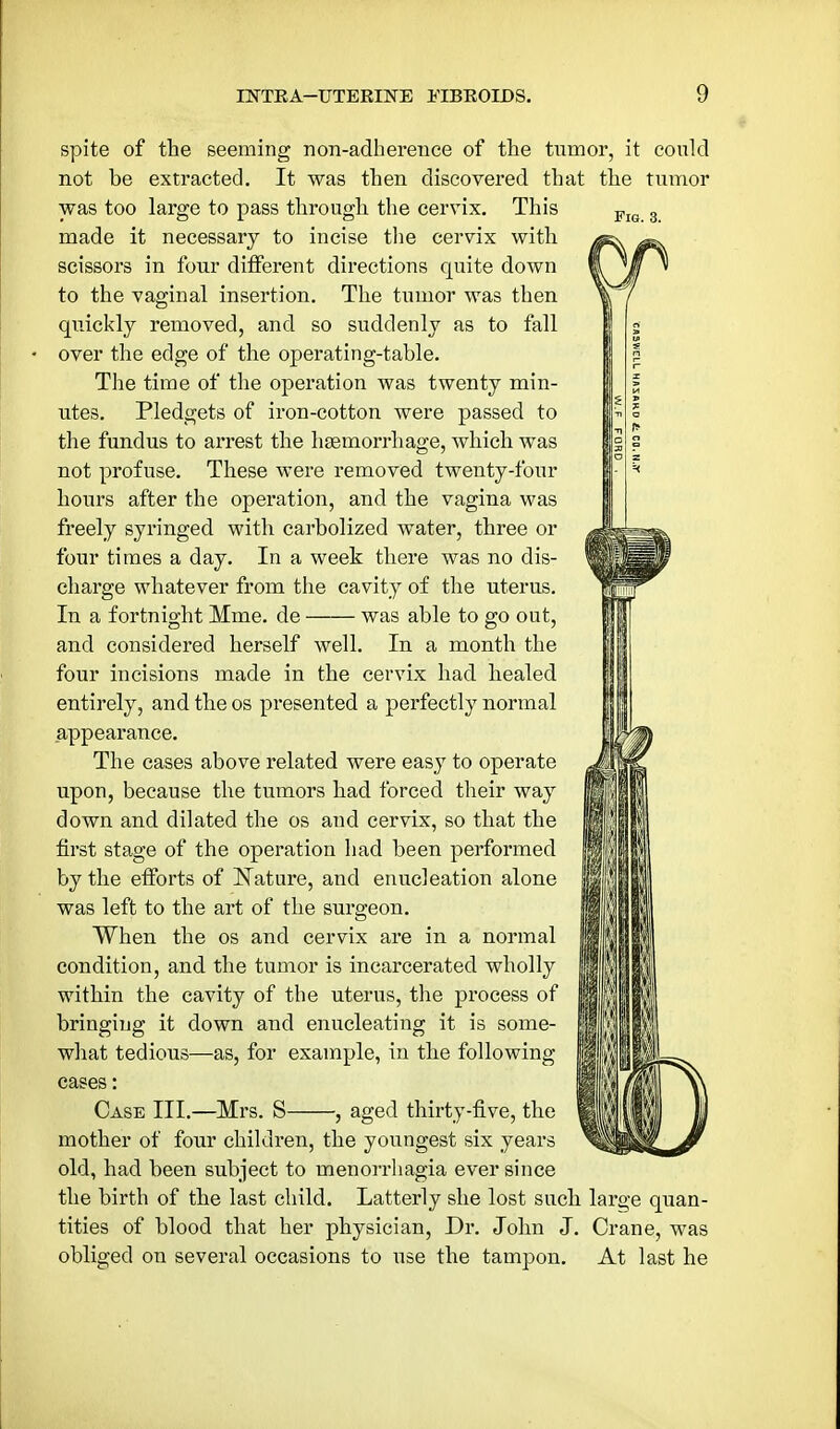 Fig. 3. spite of the seeming non-adherence of the tnmor, it could not be extracted. It was then discovered that the tumor was too large to pass through the cervix. This made it necessary to incise the cervix with scissors in four different directions quite down to the vaginal insertion. The tumor was then quickly removed, and so suddenly as to fall over the edge of the operating-table. The time of the operation was twenty min- utes. Pledgets of iron-cotton were passed to the fundus to arrest the haemorrhage, which was not profuse. These were removed twenty-four hours after the operation, and the vagina was freely syringed with carbolized water, three or four times a day. In a week there was no dis- charge whatever from the cavity of the uterus. In a fortnight Mme. de was able to go out, and considered herself well. In a month the four incisions made in the cervix had healed } entirely, and the os presented a perfectly normal appearance. The cases above related were easy to operate upon, because the tumors had forced their way down and dilated the os and cervix, so that the first stage of the operation had been performed by the efforts of Nature, and enucleation alone was left to the art of the surgeon. When the os and cervix are in a normal condition, and the tumor is incarcerated wholly within the cavity of the uterus, the process of bringing it down and enucleating it is some- what tedious—as, for example, in the following cases: Case III.—Mrs. S , aged thirty-five, the mother of four children, the youngest six years old, had been subject to menorrhagia ever since the birth of the last child. Latterly she lost such large quan- tities of blood that her physician. Dr. John J. Crane, was obliged on several occasions to use the tampon. At last he