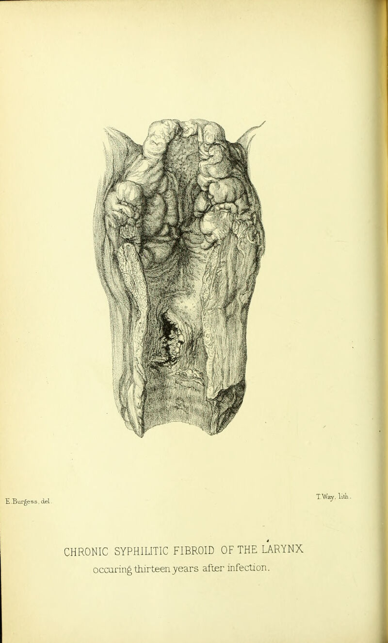 E.Burgess, del T-Way, lith • CHRONIC SYPHILITIC FIBROID OF THE LARYNX occuring thirteen years after infection.