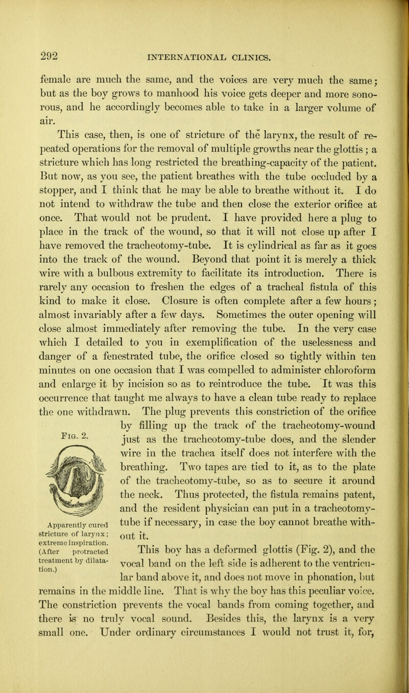 female are much the same, and the voices are very much the same; but as the boy grows to manhood his voice gets deeper and more sono- rous, and he accordingly becomes able to take in a larger volume of air. This case, then, is one of stricture of the larynx, the result of re- peated operations for the removal of multiple growths near the glottis ; a stricture which has long restricted the breathing-capacity of the patient. But now, as you see, the patient breathes with the tube occluded by a stopper, and I think that he may be able to breathe without it. I do not intend to withdraw the tube and then close the exterior orifice at once. That would not be prudent. I have provided here a plug to place in the track of the wound, so that it will not close up after I have removed the tracheotomy-tube. It is cylindrical as far as it goes into the track of the wound. Beyond that point it is merely a thick wire with a bulbous extremity to facilitate its introduction. There is rarely any occasion to freshen the edges of a tracheal fistula of this kind to make it close. Closure is often complete after a few hours ; almost invariably after a few days. Sometimes the outer opening will close almost immediately after removing the tube. In the very case which I detailed to you in exemplification of the uselessness and danger of a fenestrated tube, the orifice closed so tightly Within ten minutes on one occasion that I was compelled to administer chloroform and enlarge it by incision so as to reintroduce the tube. It was this occurrence that taught me always to have a clean tube ready to replace the one withdrawn. The plug prevents this constriction of the orifice by filling up the track of the tracheotomy-wound just as the tracheotomy-tube does, and the slender wire in the trachea itself does not interfere with the breathing. Two tapes are tied to it, as to the plate of the tracheotomy-tube, so as to secure it around the neck. Thus protected, the fistula remains patent, and the resident physician can put in a tracheotomy- Apparentiy cured tube if necessary, in case the boy cannot breathe with- stricture of larynx; j£ extreme inspiration.  . _ (After protracted This boy has a deformed glottis {h lg. 2), and the treatment by diiata- vocai band on the left side is adherent to the ventricu- tion.) lar band above it, and does not move in phonation, but remains in the middle line. That is why the boy has this peculiar voice. The constriction prevents the vocal bands from coming together, and there is no truly vocal sound. Besides this, the larynx is a very small one. Under ordinary circumstances I would not trust it, for,