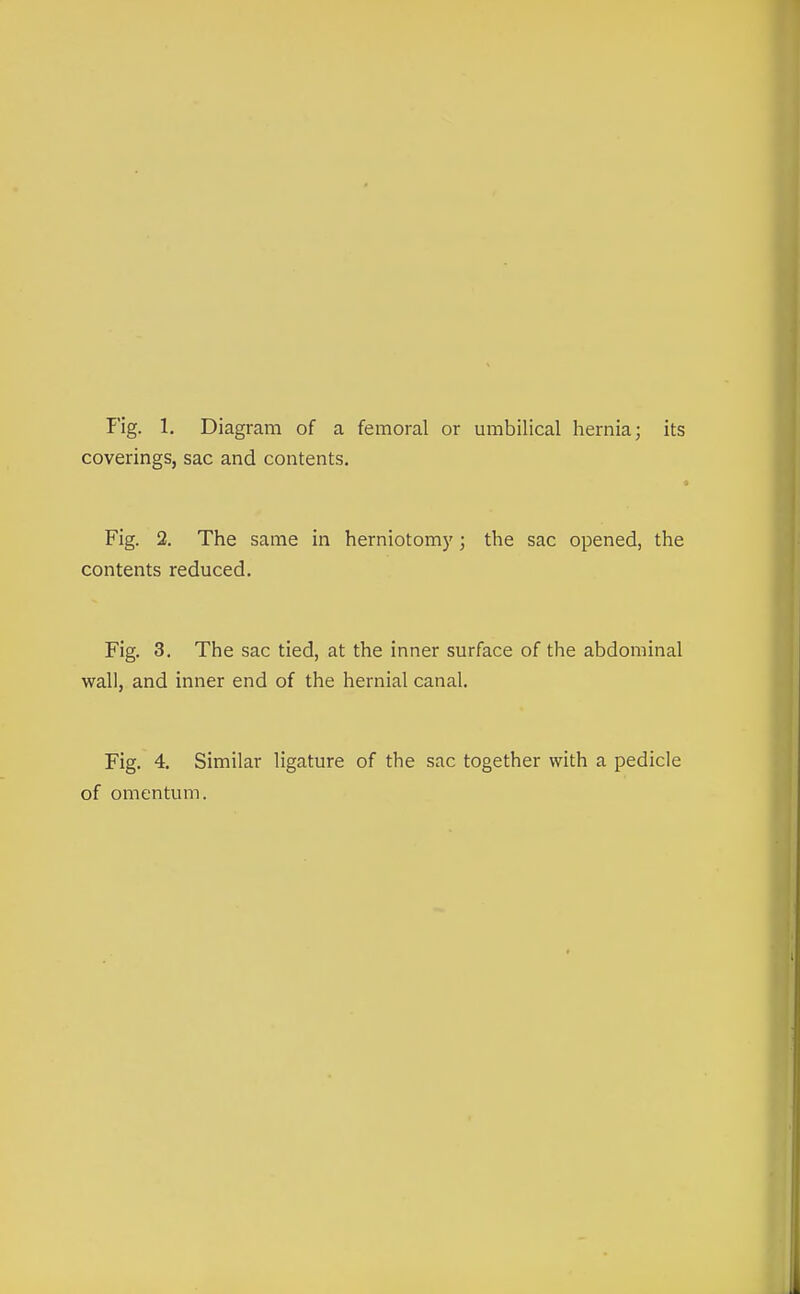 coverings, sac and contents. Fig. 2. The same in herniotomy; the sac opened, the contents reduced. Fig. 3. The sac tied, at the inner surface of the abdominal wall, and inner end of the hernial canal. Fig. 4, Similar ligature of the sac together with a pedicle of omentum.