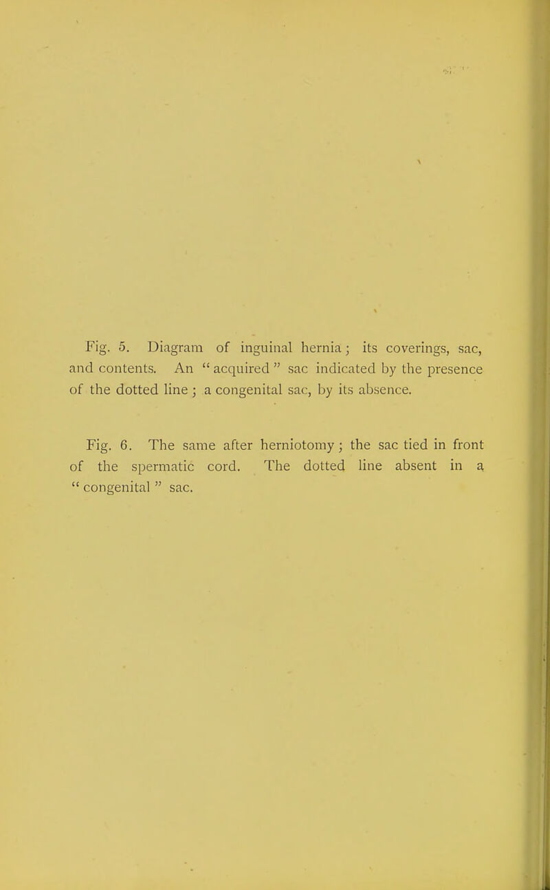 and contents. An  acquired  sac indicated by the presence of the dotted line ; a congenital sac, by its absence. Fig. 6. The same after herniotomy; the sac tied in front of the spermatic cord. The dotted line absent in a,  congenital  sac.