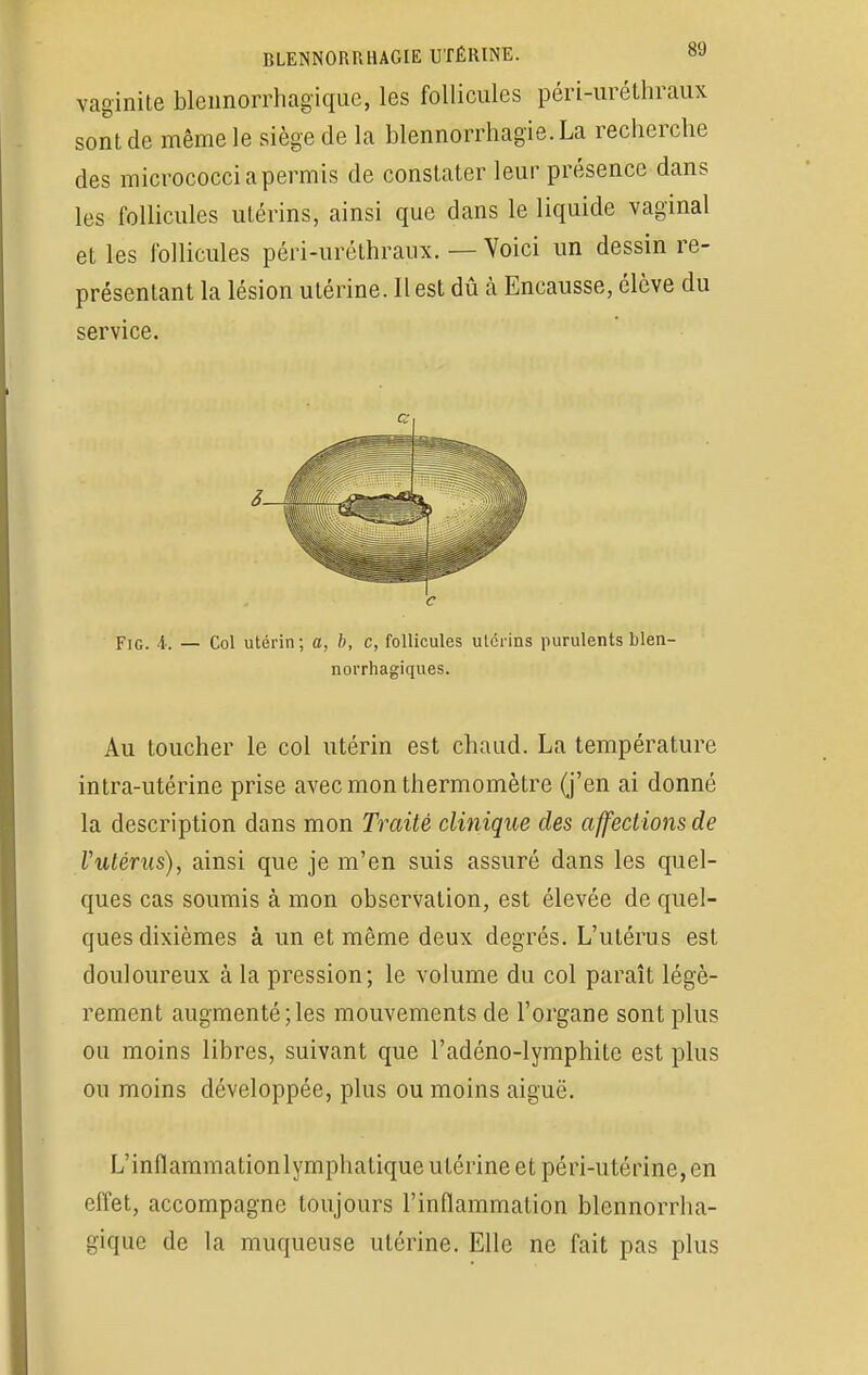 vaginite blcnnorrhagiquc, les follicules péri-urélhraux sont de même le siège de la blennorrhagie.La recherche des micrococci a permis de constater leur présence dans les follicules utérins, ainsi que dans le liquide vaginal et les follicules péri-urélhraux. — Voici un dessin re- présentant la lésion utérine. Il est dû à Encausse, élève du service. Fig. A: — Col utérin; a, b, c, follicules ulérins purulents blen- Au toucher le col utérin est chaud. La température intra-utérine prise avec mon thermomètre (j'en ai donné la description dans mon Traité clinique des affections de l'utérus), ainsi que je m'en suis assuré dans les quel- ques cas soumis à mon observation, est élevée de quel- ques dixièmes à un et même deux degrés. L'utérus est douloureux à la pression; le volume du col paraît légè- rement augmenté;les mouvements de l'organe sont plus ou moins libres, suivant que l'adéno-lymphite est plus ou moins développée, plus ou moins aiguë. L'inflammationlymphatique utérine et péri-utérine, en effet, accompagne toujours l'inflammation blennorrha- giquc de la muqueuse utérine. Elle ne fait pas plus c norrhagiques.