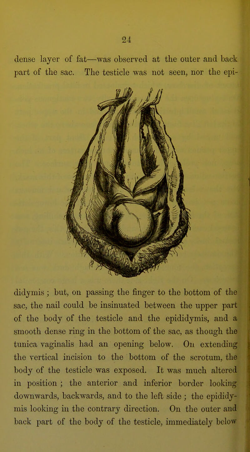 dense layer of fat—was observed at the outer and back part of the sac. The testicle was not seen, nor the epi- didymis ; but, on passing the finger to the bottom of the sac, the nail could be insinuated between the upper part of the body of the testicle and the epididymis, and a smooth dense ring in the bottom of the though the tunica vaginahs had an opening below. On extending the vertical incision to the bottom of the scrotum, the body of the testicle was exposed. It was much altered in position ; the anterior and inferior border looking downwards, backwards, and to the left side ; the epididy- mis looking in the contrary direction. On the outer and back part of the body of the testicle, immediately below