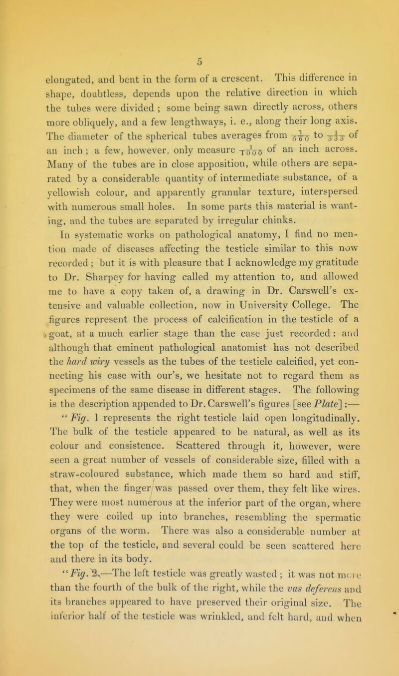 elongated, and bent in the form of a crescent. This difference in shape, doubtless, depends upon the relative direction in which the tubes were divided ; some being sawn directly across, others more obliquely, and a few lengthways, i. e., along their long axis. The diameter of the spherical tubes averages from -^^^ to -g-^-g- of an inch ; a few, however, only measure tuVo ^^^ across. Many of the tubes are in close apposition, while others are sepa- rated by a considerable quantity of intermediate substance, of a yellowish colour, and apparently granular texture, interspersed with numerous small holes. In some parts this material is want- ing, and the tubes are separated by irregular chinks. In systematic works on pathological anatomy, I find no men- tion made of diseases affecting the testicle similar to this now recorded ; but it is with pleasure that I acknowledge my gratitude to Dr. Sharpey for having called my attention to, and allowed me to have a copy taken of, a drawing in Dr. CarsweU's ex- tensive and valuable collection, now in University College. The figures represent the process of calcification in the testicle of a ,- goat, at a much earlier stage than the case just recorded : and although that eminent pathological anatomist has not described the hard wiry vessels as the tubes of the testicle calcified, yet con- necting his case with our's, we hesitate not to regard them as specimens of the same disease in difl^erent stages. The following is the description appended to Dr. CarsweU's figures [see Plate] :—  Fig. 1 represents the right testicle laid open longitudinally. The bulk of the testicle apj)eared to be natural, as well as its colour and consistence. Scattered through it, however, were seen a great number of vessels of considerable size, filled with a straw-coloured substance, which made them so hard and stiff, that, when the finger was passed over them, they felt like wires. They were most numerous at the inferior part of the organ, where they were coiled up into branches, resembling the spermatic organs of the worm. There was also a considerable number at the top of the testicle, and several could be seen scattered here and there in its body. Fig. %—The left testicle was greatly wasted ; it was not nv^.rv than the fourth of the bulk of the right, while the vas deferens and its branches appeared to have preserved their original size. The inferior half of the testicle was wrinkled, and felt hard, and when