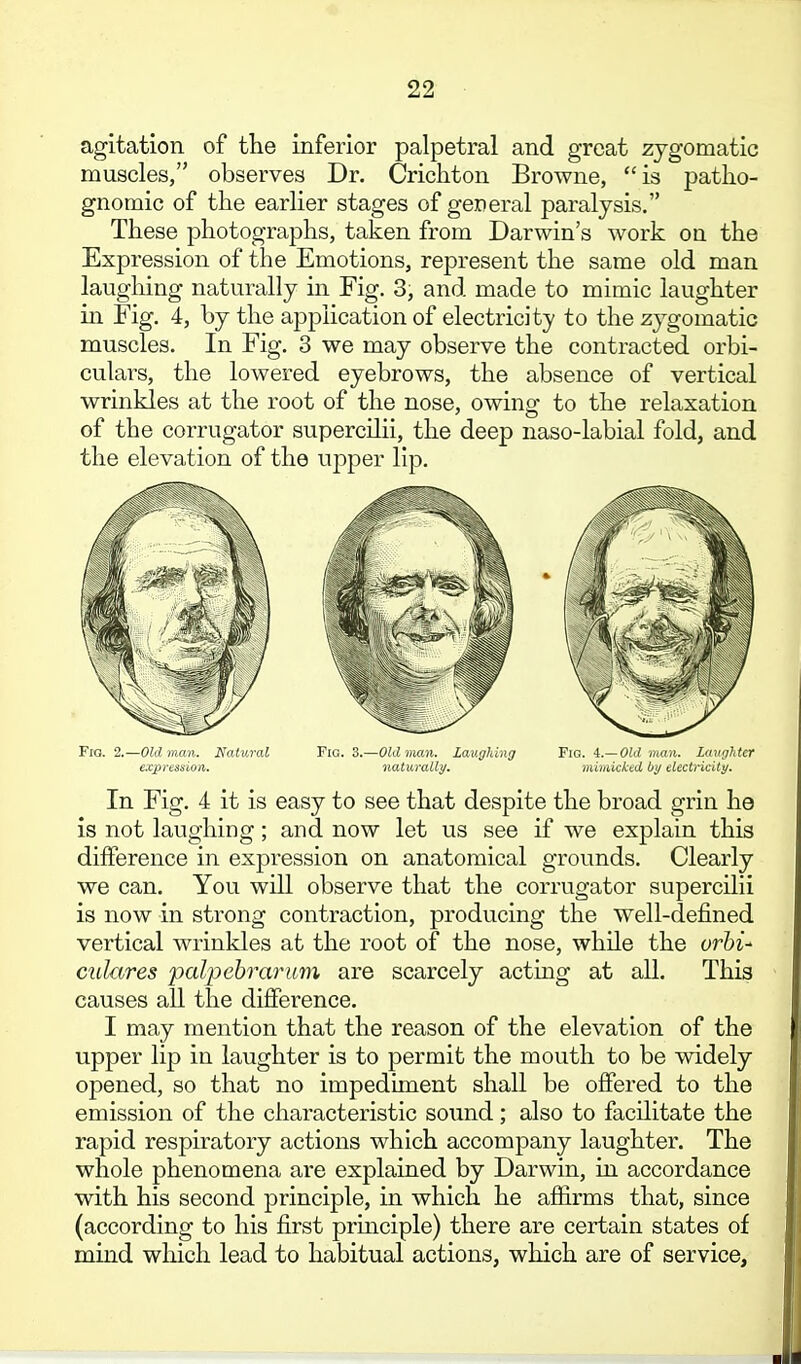 agitation of tKe inferior palpetral and great zygomatic muscles, observes Dr. Crichton Browne, is patlio- gnomic of the earlier stages of general paralysis, These photographs, taken from Darwin's work on the Expression of the Emotions, represent the same old man laughing naturally in Fig. 3, and made to mimic laughter in Fig. 4, by the application of electricity to the zygomatic muscles. In Fig. 3 we may observe the contracted orbi- culars, the lowered eyebrows, the absence of vertical wrinkles at the root of the nose, owing to the relaxation of the corrugator supercilii, the deep naso-labial fold, and the elevation of the upper lip. Fig. 2.—Oldman. Natural Fia. 3.—Oldman. Laughing Fig. i.— Old man. Laughter expression. naturalli/. mbnicked by electricity. In Fig. 4 it is easy to see that despite the broad grin he is not laughing; and now let us see if we explain this difference in expression on anatomical grounds. Clearly we can. You will observe that the corrugator supercilii is now in strong contraction, producing the well-defined vertical wrinkles at the root of the nose, while the orbi^ culares palpebrarum are scarcely actmg at all. This causes all the difference. I may mention that the reason of the elevation of the upper lip in laughter is to permit the mouth to be widely opened, so that no impediment shall be offered to the emission of the characteristic sound; also to facilitate the rapid respiratory actions which accompany laughter. The whole phenomena are explained by Darwin, in accordance with his second principle, in which he affirms that, since (according to his first principle) there are certain states of mind which lead to habitual actions, which are of service,