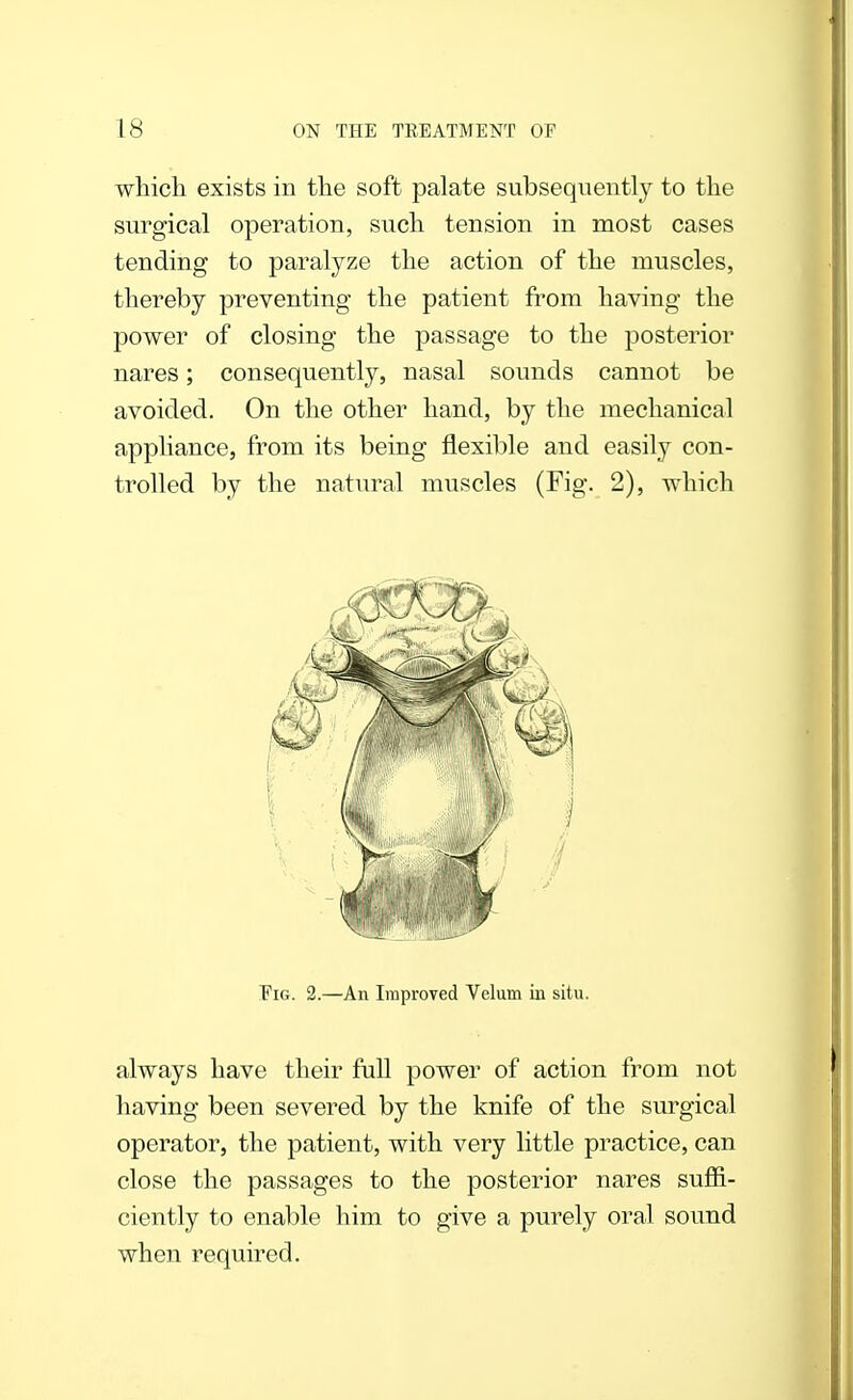 which exists in the soft palate subsequently to the surgical operation, such tension in most cases tending to paralyze the action of the muscles, thereby preventing the patient from having the power of closing the passage to the posterior nares; consequently, nasal sounds cannot be avoided. On the other hand, by the mechanical appliance, from its being flexible and easily con- trolled by the natural muscles (Fig. 2), which Fig. 2.—An Improved Velum in situ. always have their full power of action from not having been severed by the knife of the surgical operator, the patient, with very little practice, can close the passages to the posterior nares suffi- ciently to enable him to give a purely oral sound when required.