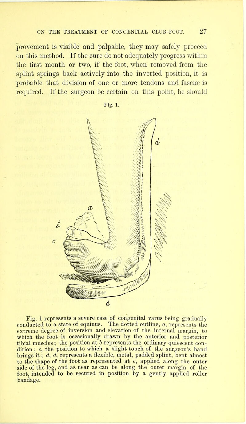 provement is visible and palpable, they may safely proceed on this method. If the cure do not adequately progress within the first month or two, if the foot, when removed from the splint springs back actively into the inverted position, it is probable that division of one or more tendons and fasciae is required. If the surgeon be certain on this point, he should Fig. 1. Fig. 1 represents a severe case of congenital varus being gradually conducted to a state of equinus. The dotted outline, a, represents the extreme degree of inversion and elevation of the internal margin, to ■which the foot is occasionally drawn by the anterior and posterior tibial muscles; the position at b represents the ordinary quiescent con- dition ; c, the position to which a slight touch of the surgeon's hand brings it; d, d, represents a flexible, metal, padded splint, bent almost to the shape of the foot as represented at c, applied along the outer side of the leg, and as near as can be along the outer margin of the foot, intended to be secured in position by a gently applied roller bandage.