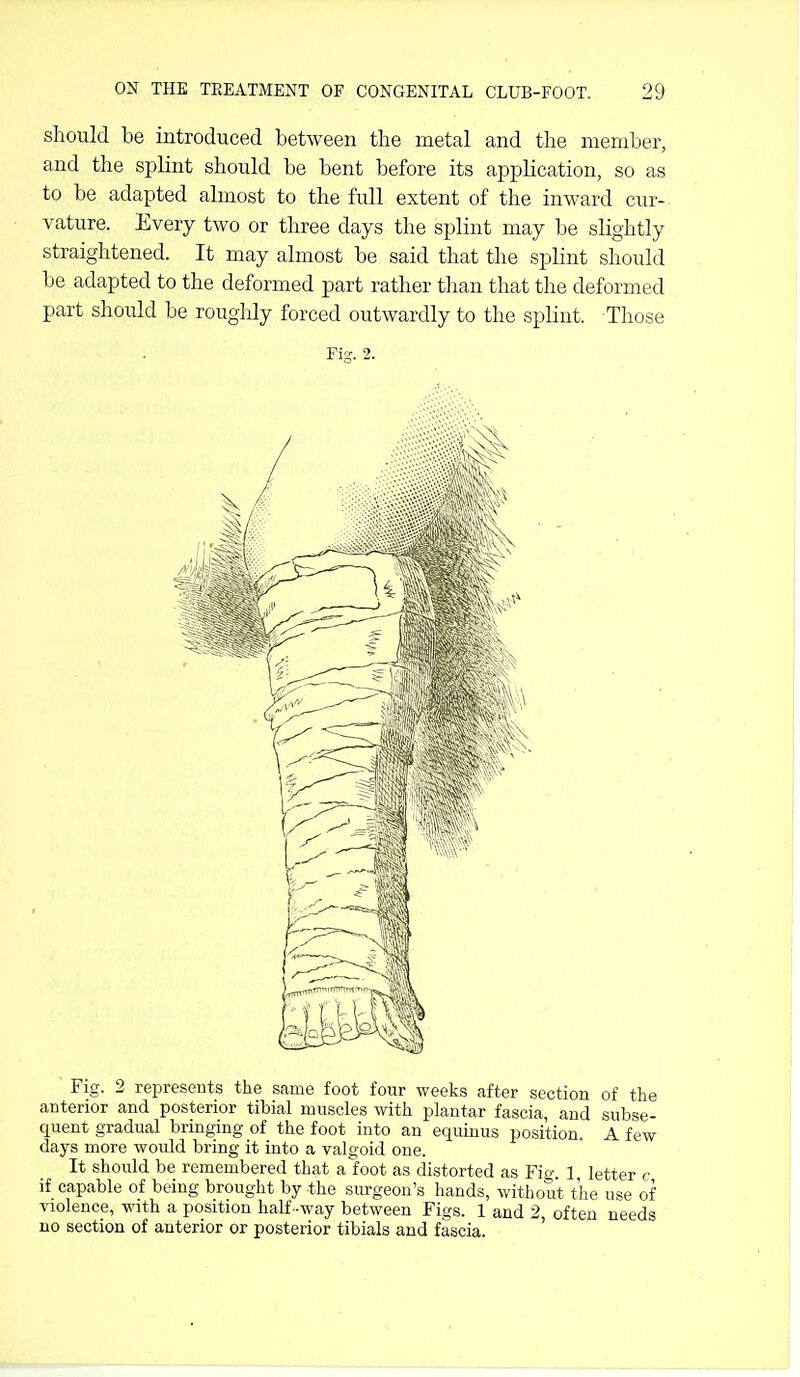 should be introduced between the metal and the member, and the splint should be bent before its application, so as to be adapted almost to the full extent of the inward cur- vature. Every two or three days the splint may be slightly straightened. It may almost be said that the splint should be adapted to the deformed part rather than that the deformed part should be roughly forced outwardly to the splint. Those Fig. 2. Fig. 2 represents the same foot four weeks after section of the anterior and posterior tibial muscles with plantar fascia, and subse- quent gradual bringing of the foot into an equinus position. A few days more would bring it into a valgoid one. It should be remembered that afoot as distorted as Fig. 1 letter c if capable of being brought by the surgeon's hands, without the use of violence, with a position half -way between Figs. 1 and 2 often needs no section of anterior or posterior tibials and fascia.