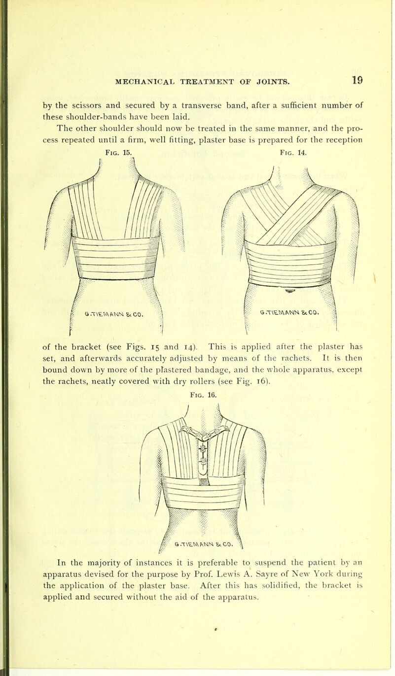by the scissors and secured by a transverse band, after a sufficient number of these shoulder-bands have been laid. The other shoulder should now be treated in the same manner, and the pro- cess repeated until a firm, well fitting, plaster base is prepared for the reception Fig. 15. Fig. 14. of the bracket (see Figs. 15 and 14). This is applied after the plaster has set, and afterwards accurately adjusted by means of the rachets. It is then bound down by more of the plastered bandage, and the whole apparatus, except the rachets, neatly covered with dry rollers (see Fig. 16). Fig. 16. In the majority of instances it is preferable to suspend the patient by an apparatus devised for the purpose by Prof. Lewis A. Sayre of New York during the application of the plaster base. After this has solidified, the bracket is applied and secured without the aid of the apparatus.