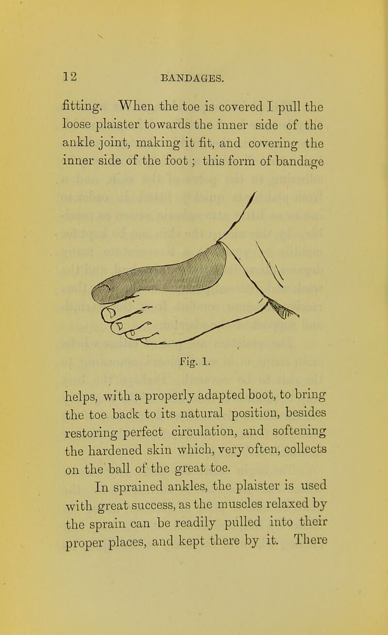 fitting. When the toe is covered I pull the loose plaister towards the inner side of the ankle joint, making it fit, and covering the inner side of the foot; this form of bandage Fig. 1. helps, with a properly adapted boot, to bring the toe back to its natural position, besides restoring perfect circulation, and softening the hardened skin which, very often, collects on the ball of the great toe. In sprained ankles, the plaister is used with great success, as the muscles relaxed by the sprain can be readily pulled into their proper places, and kept there by it. There
